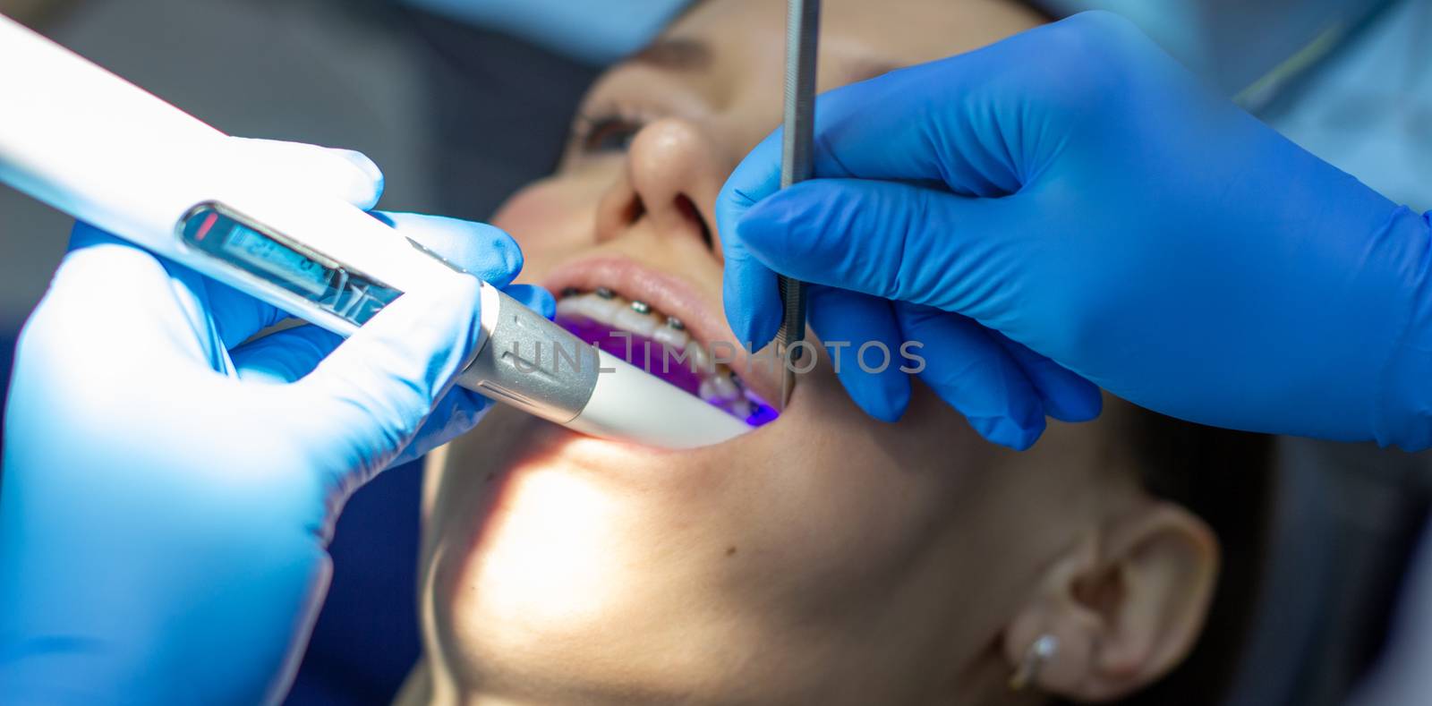 A woman with dental braces visits an orthodontist at the clinic. in the dental chair during the procedure of installing braces on the upper and lower teeth. Dentist and assistant work together, they have dental instruments in their hands. concept of dentistry