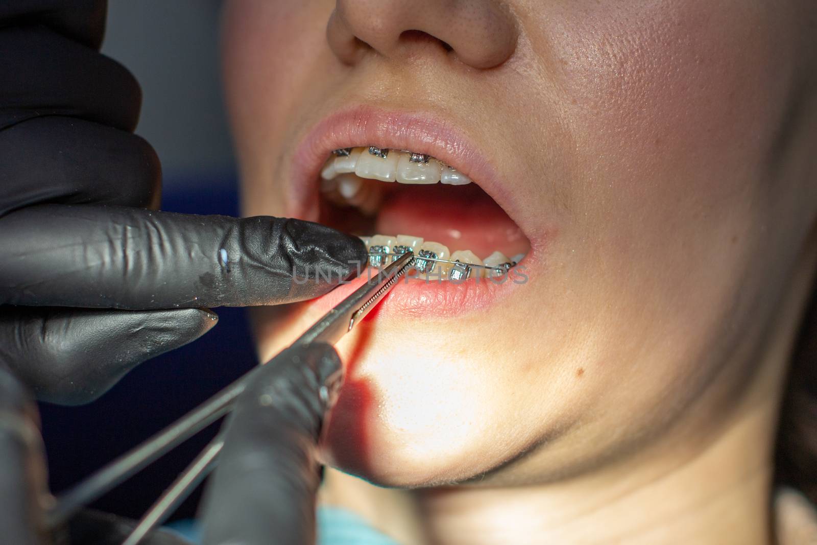 A woman with dental braces visits an orthodontist in the clinic, in a dental chair. during the procedure of installing the arch of braces on the upper and lower teeth. The dentist is wearing gloves and has dental instruments in his hands. The concept of dentistry