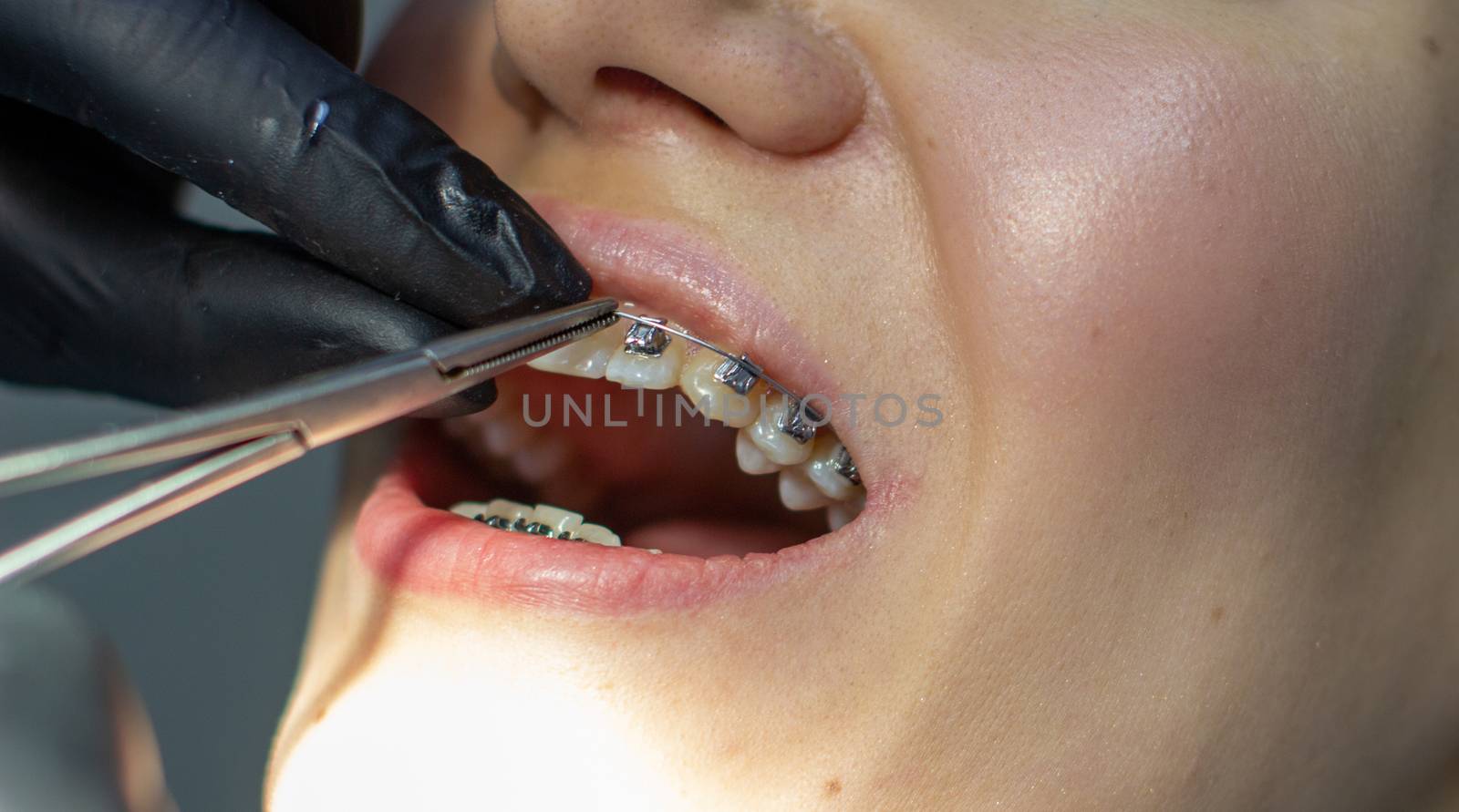 A woman with dental braces visits an orthodontist in the clinic, in a dental chair. during the procedure of installing the arch of braces on the upper and lower teeth. The dentist is wearing gloves and has dental instruments in his hands. The concept of dentistry