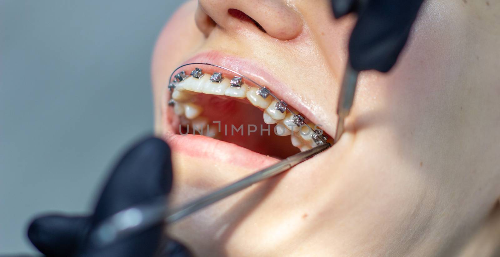 A woman at a dentist's appointment to replace arches with braces. by AnatoliiFoto