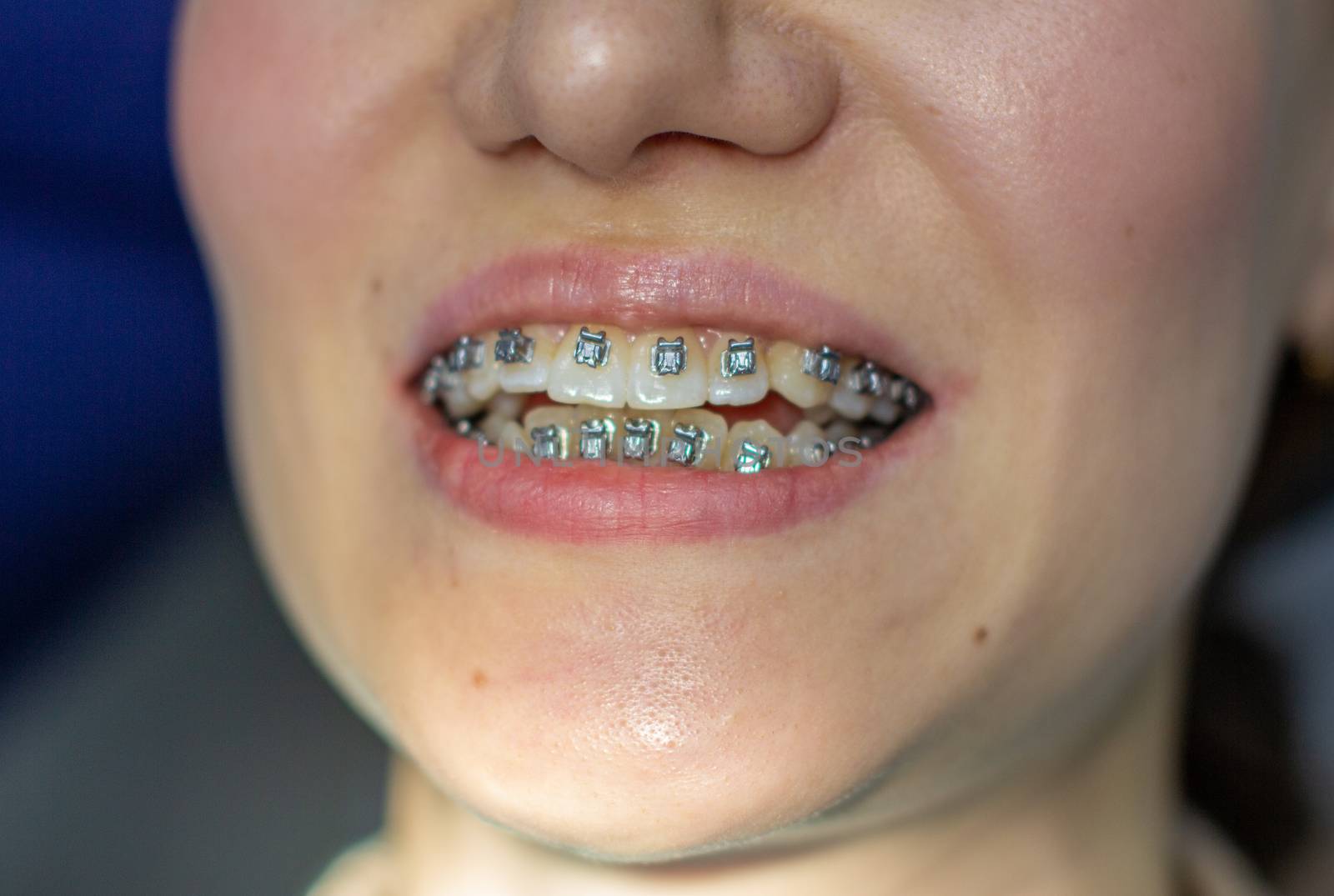 A woman at a dentist's appointment to replace arches with braces. by AnatoliiFoto