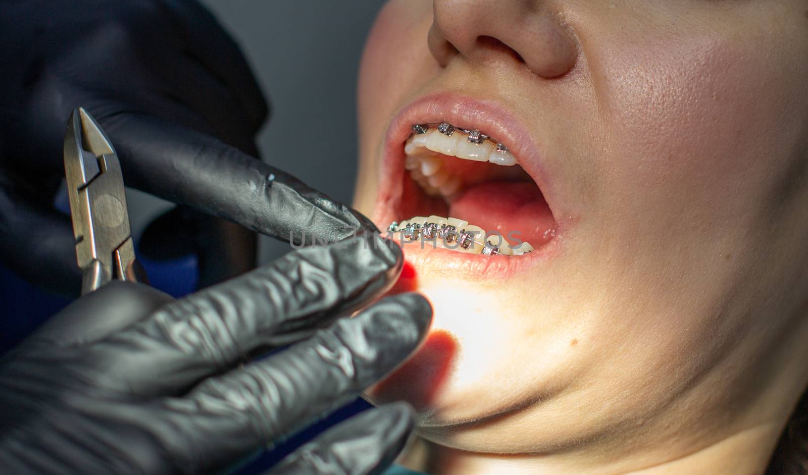 A woman with braces on her teeth visits an orthodontist in a dental chair. during the procedure of installing the arch of braces on the upper and lower teeth. The doctor examines the teeth. dentistry