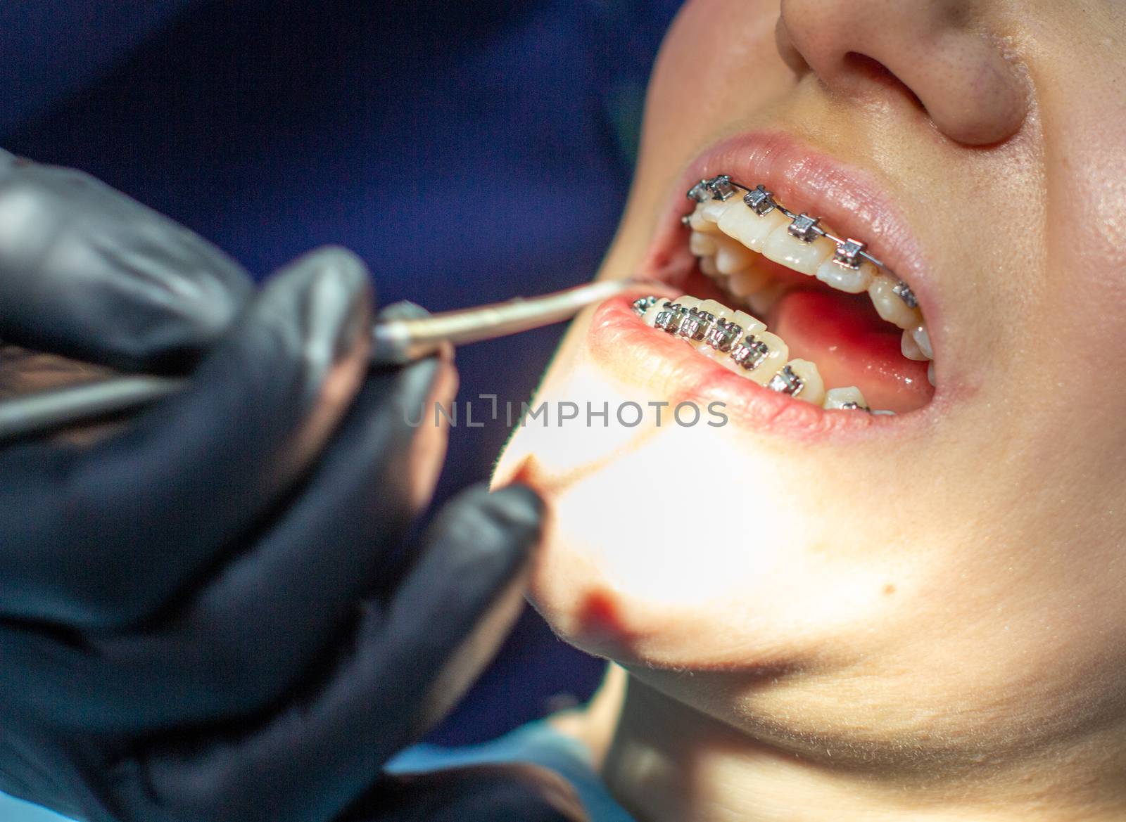 A woman with braces on her teeth visits an orthodontist in a dental chair. during the procedure of installing the arch of braces on the upper and lower teeth. The doctor examines the teeth. dentistry