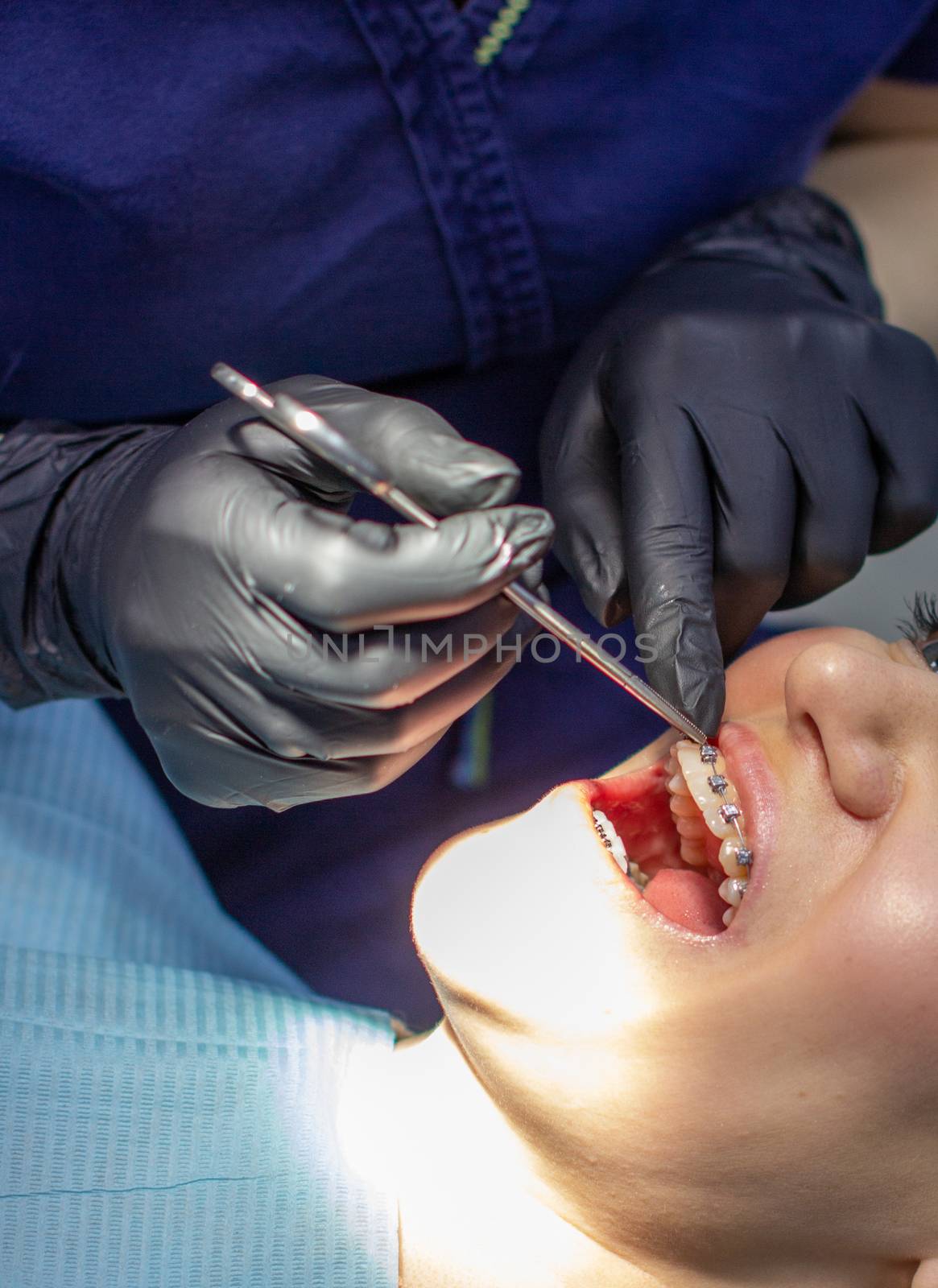 A woman at a dentist's appointment to replace arches with braces. by AnatoliiFoto