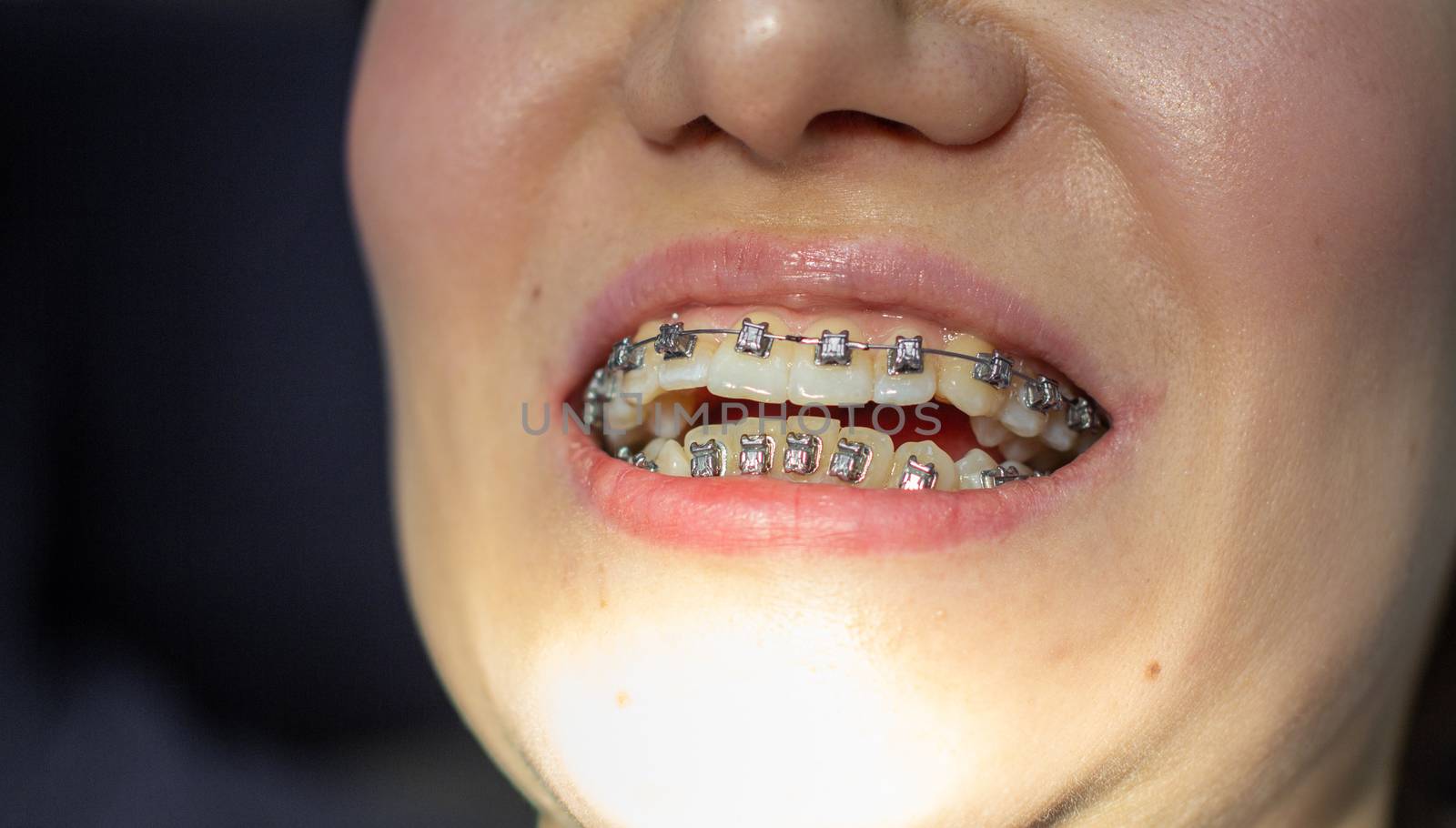 A woman at a dentist's appointment to replace arches with braces. by AnatoliiFoto