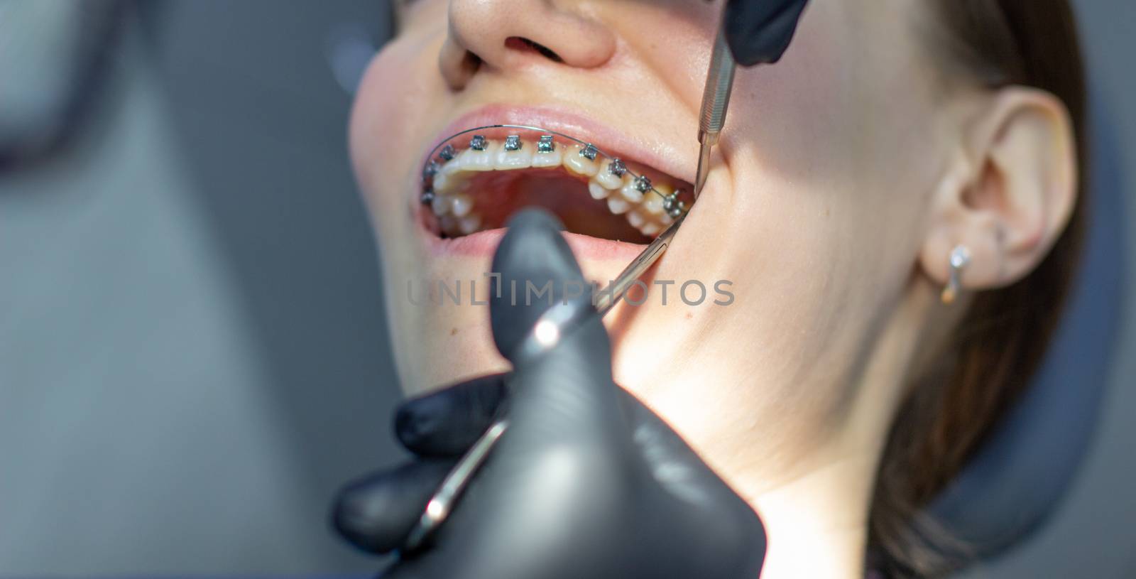 A woman with dental braces visits an orthodontist in the clinic, in a dental chair. during the procedure of installing the arch of braces on the upper and lower teeth. The dentist is wearing gloves and has dental instruments in his hands. The concept of dentistry