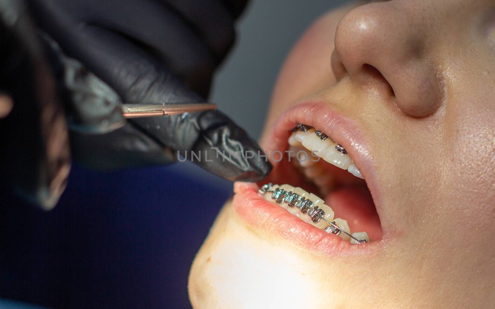 A woman with braces visits an orthodontist, in a dental chair. during the procedure of installing the arch of braces on the lower teeth. The dentist is wearing gloves and holding a pair of forceps. 