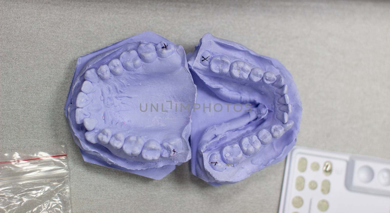 Plaster cast of teeth from plaster at the orthodontist. Model of the jaw and teeth for installing braces.