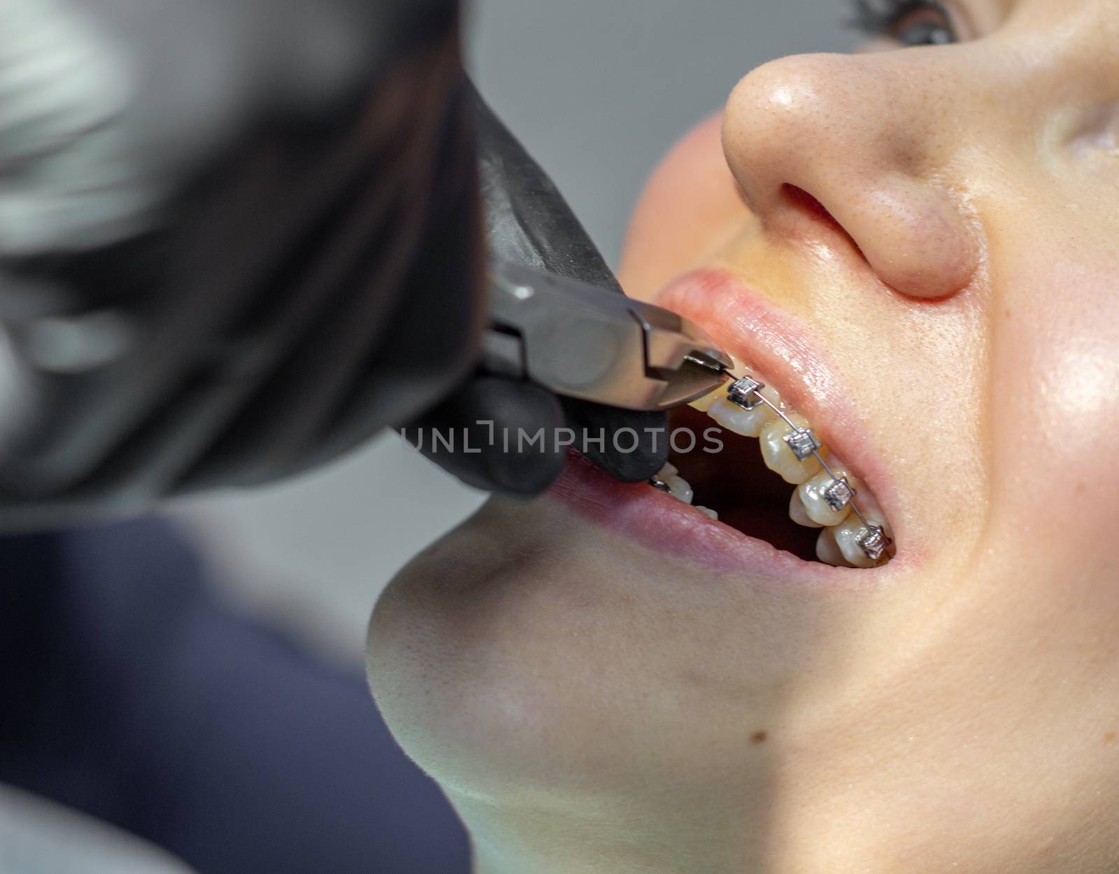 A woman at a dentist's appointment to replace arches with braces. by AnatoliiFoto