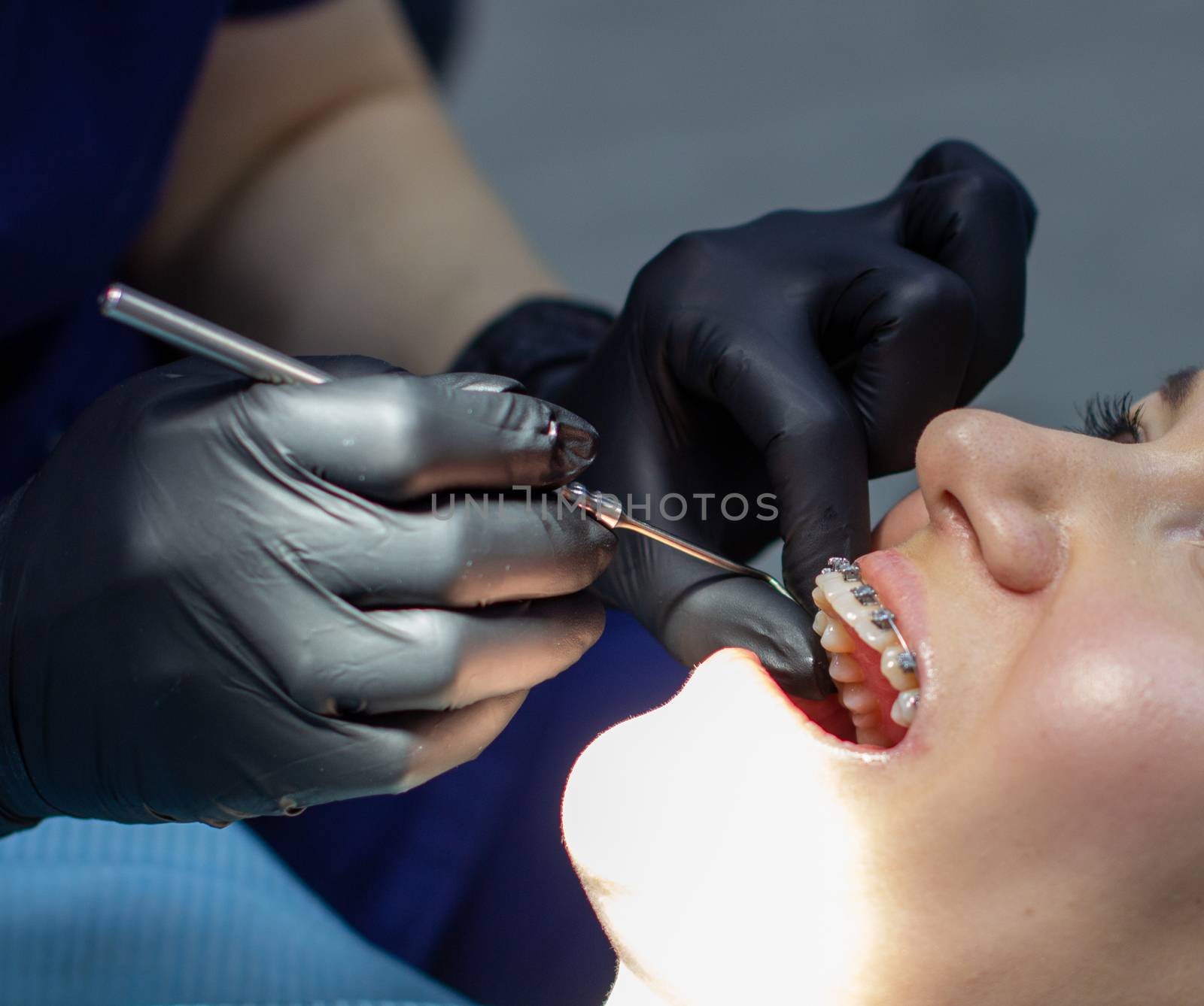 woman with braces visits an orthodontist, in a dental chair.during the procedure of installing the arch of braces on the upper and lower teeth.The dentist is wearing gloves and has tools in his hands.