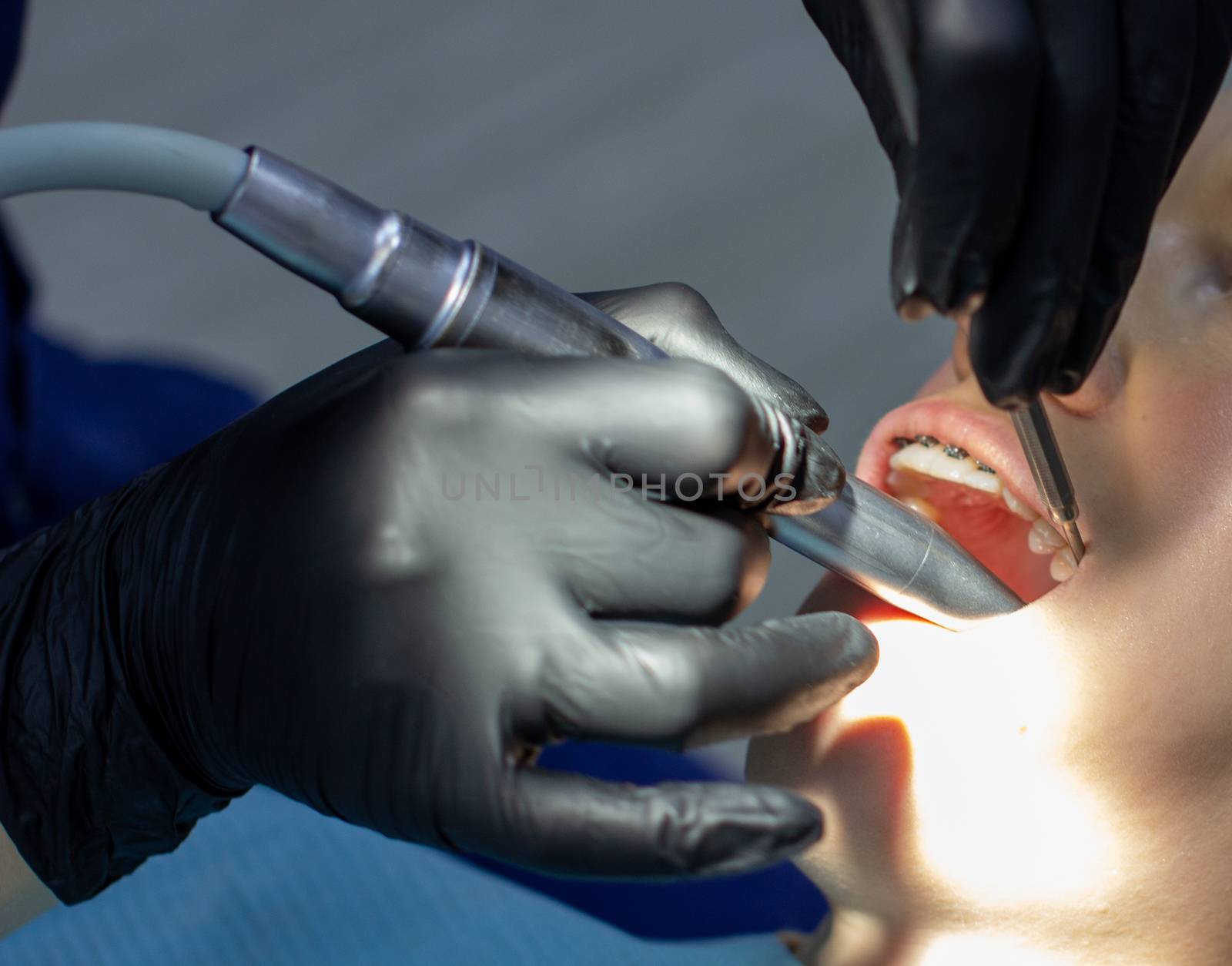 A woman with dental braces visits an orthodontist at the clinic. in the dental chair during the procedure of installing braces on the upper and lower teeth. Dentist and assistant work together, they have dental instruments in their hands. concept of dentistry