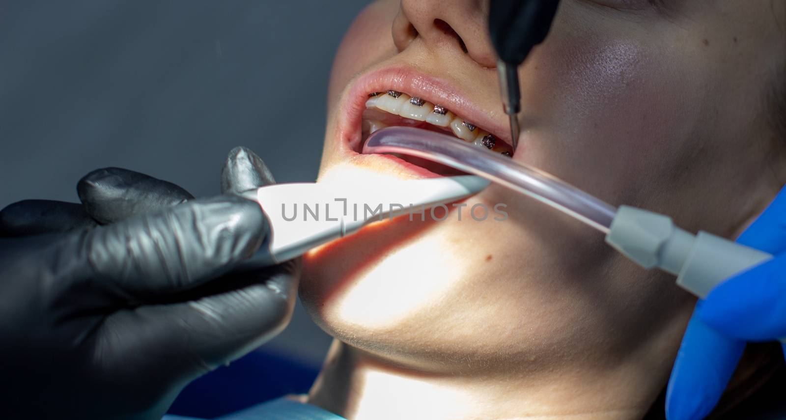 A woman with dental braces visits an orthodontist at the clinic. in the dental chair during the procedure of installing braces on the upper and lower teeth. Dentist and assistant work together, they have dental instruments in their hands. concept of dentistry