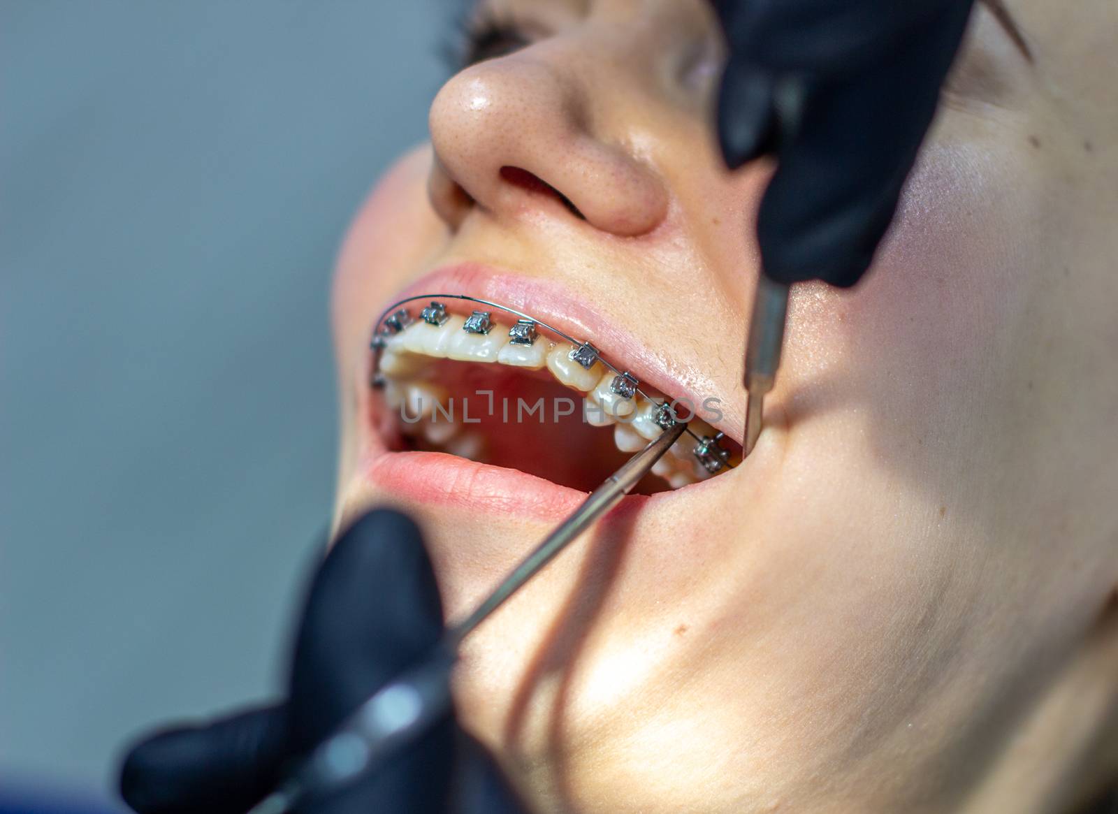 A woman with dental braces visits an orthodontist in the clinic, in a dental chair. during the procedure of installing the arch of braces on the upper and lower teeth. The dentist is wearing gloves and has dental instruments in his hands. The concept of dentistry