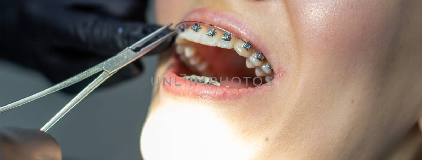 A woman with dental braces visits an orthodontist in the clinic, in a dental chair. during the procedure of installing the arch of braces on the upper and lower teeth. The dentist is wearing gloves and has dental instruments in his hands. The concept of dentistry