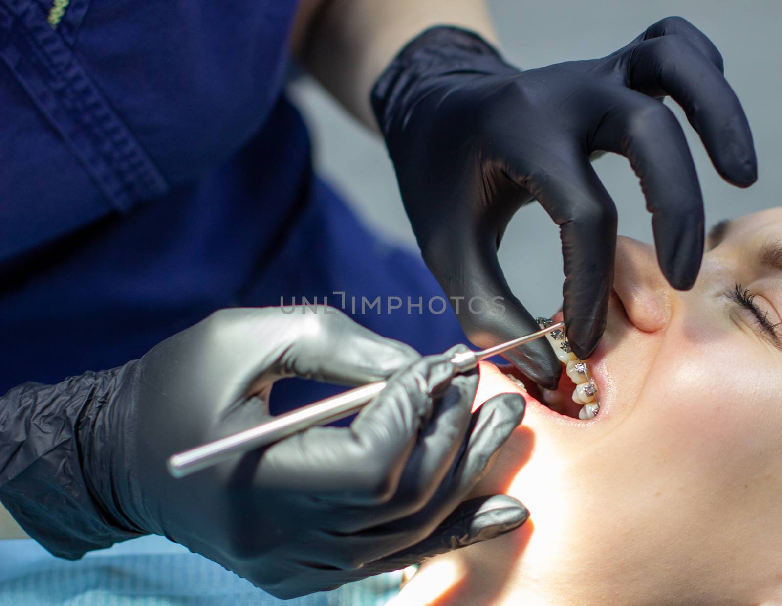 A woman at a dentist's appointment to replace arches with braces. by AnatoliiFoto