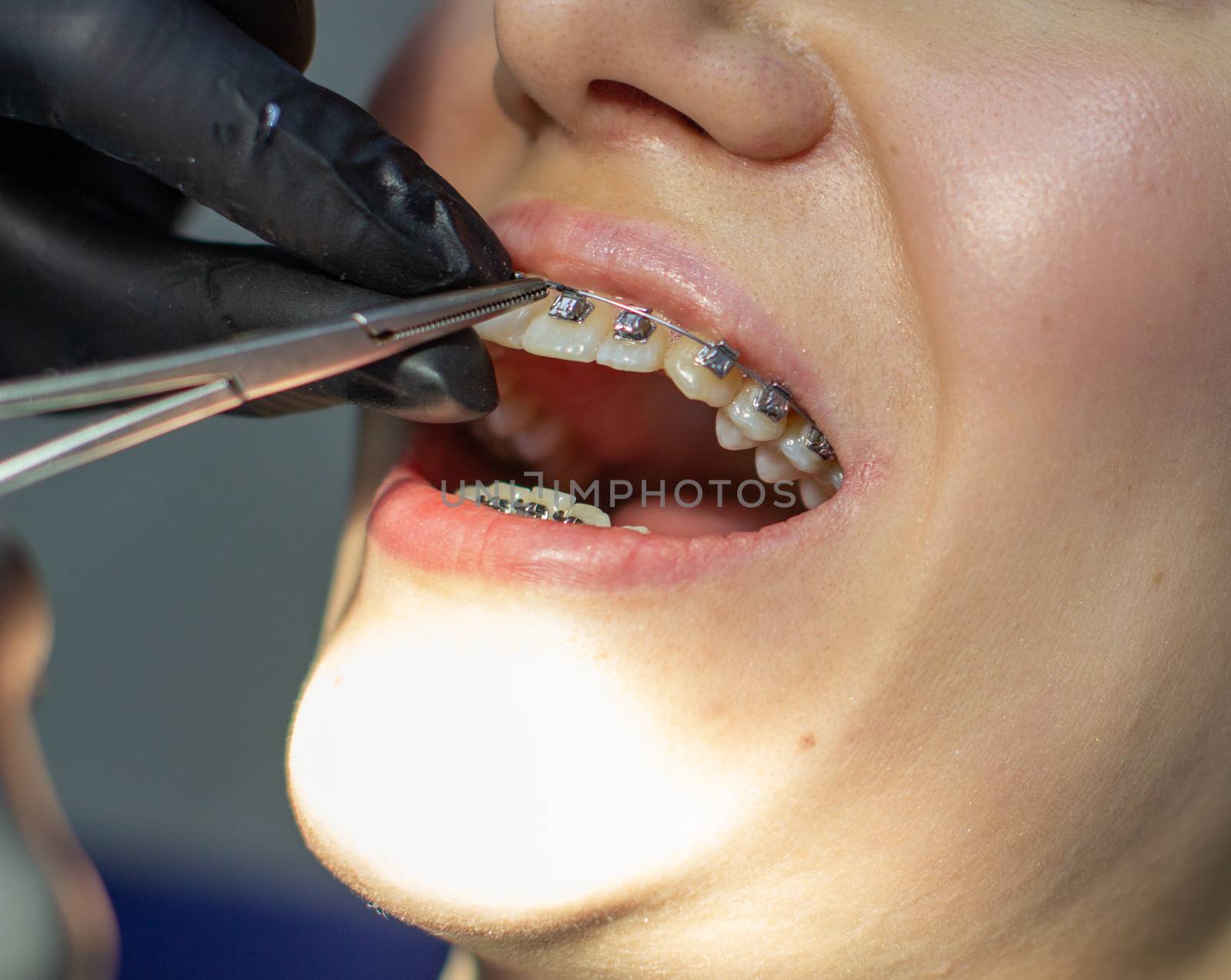 A woman with dental braces visits an orthodontist in the clinic, in a dental chair. during the procedure of installing the arch of braces on the upper and lower teeth. The dentist is wearing gloves and has dental instruments in his hands. The concept of dentistry