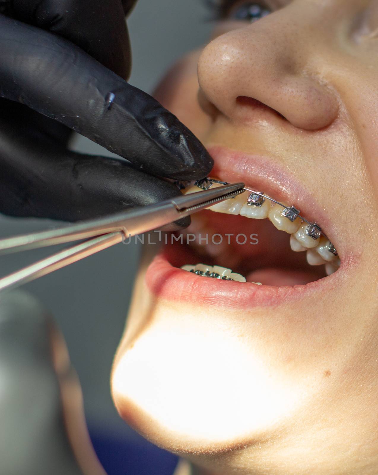 A woman with dental braces visits an orthodontist in the clinic, in a dental chair. during the procedure of installing the arch of braces on the upper and lower teeth. The dentist is wearing gloves and has dental instruments in his hands. The concept of dentistry