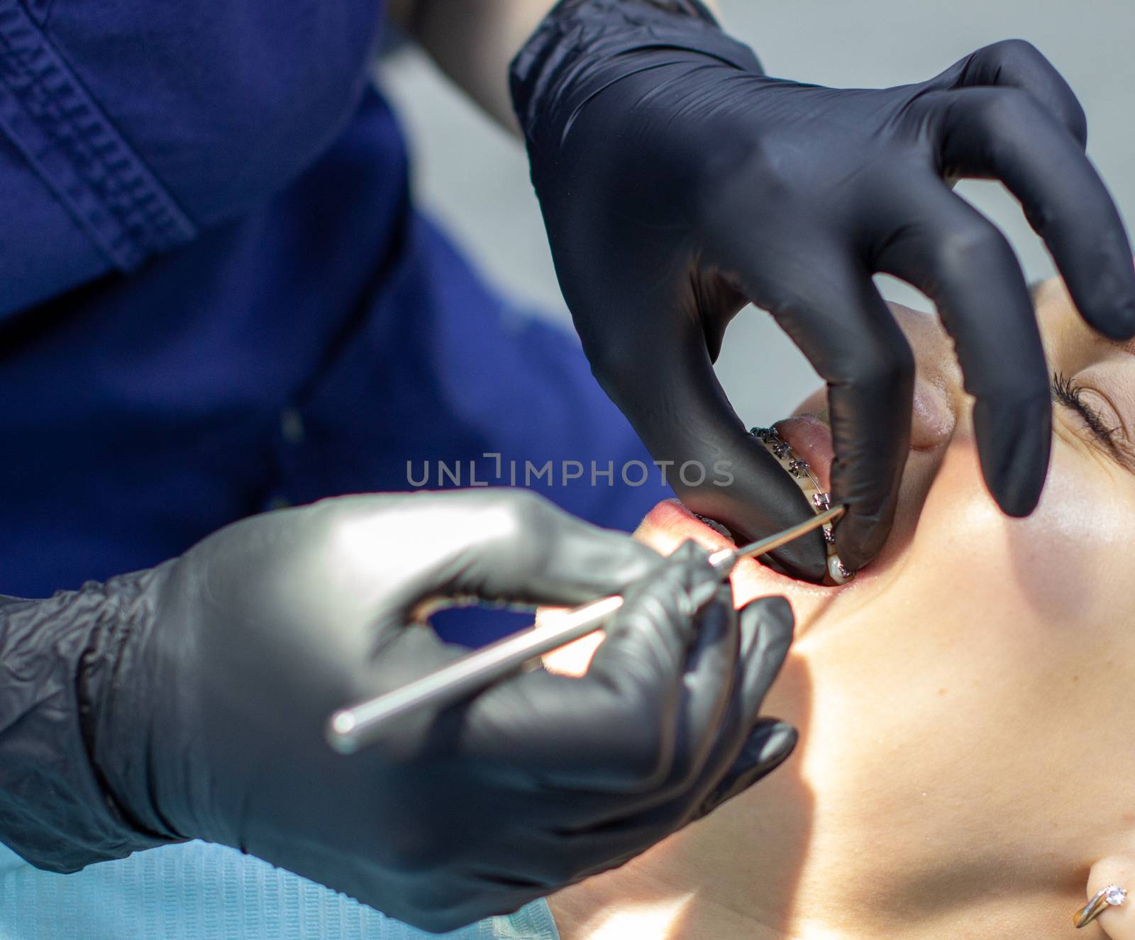 woman with braces visits an orthodontist, in a dental chair.during the procedure of installing the arch of braces on the upper and lower teeth.The dentist is wearing gloves and has tools in his hands.