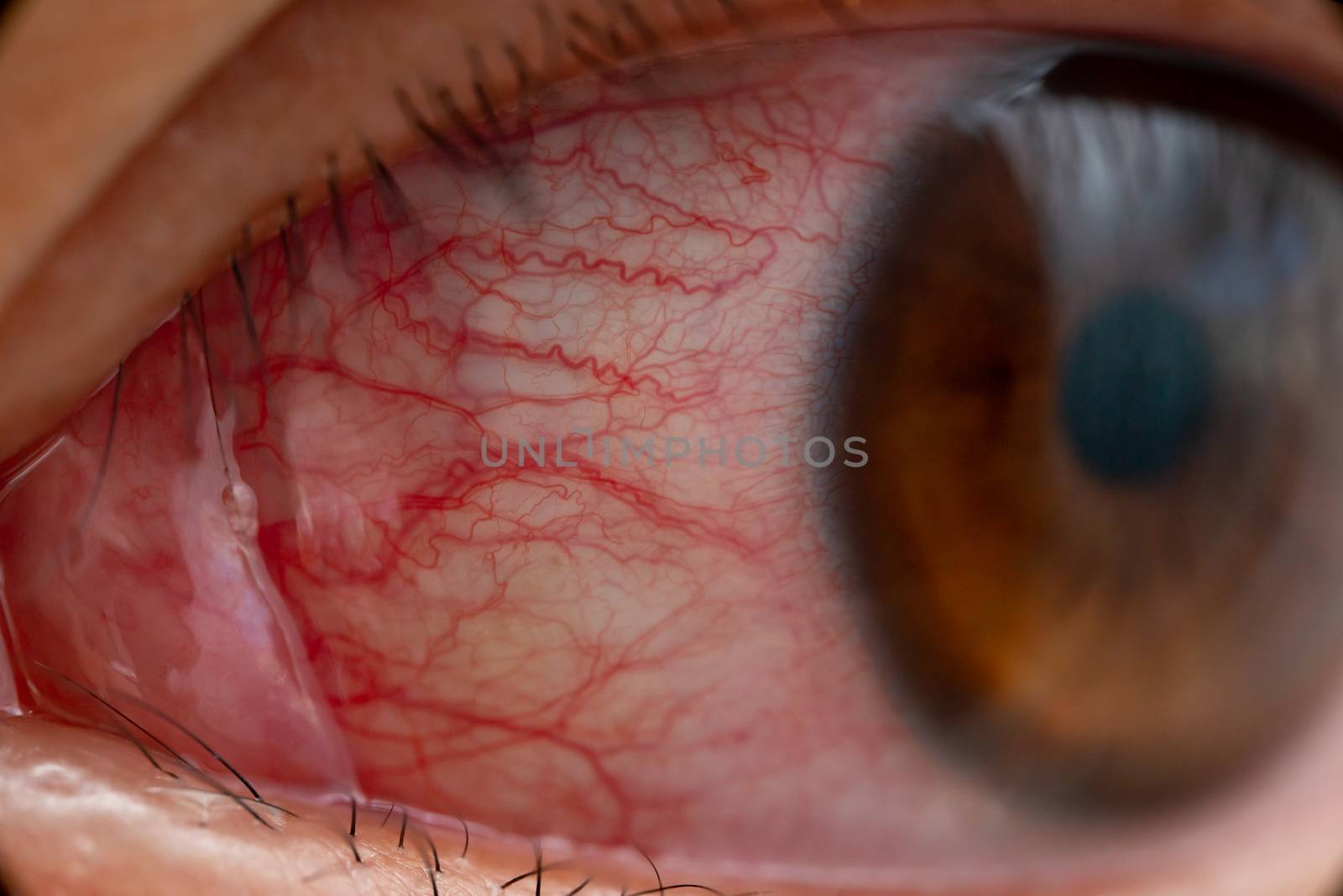 Closeup of irritated or infected red bloodshot eye - conjunctivitis. Red eye of woman, conjunctivitis eye, allergy or after cry.