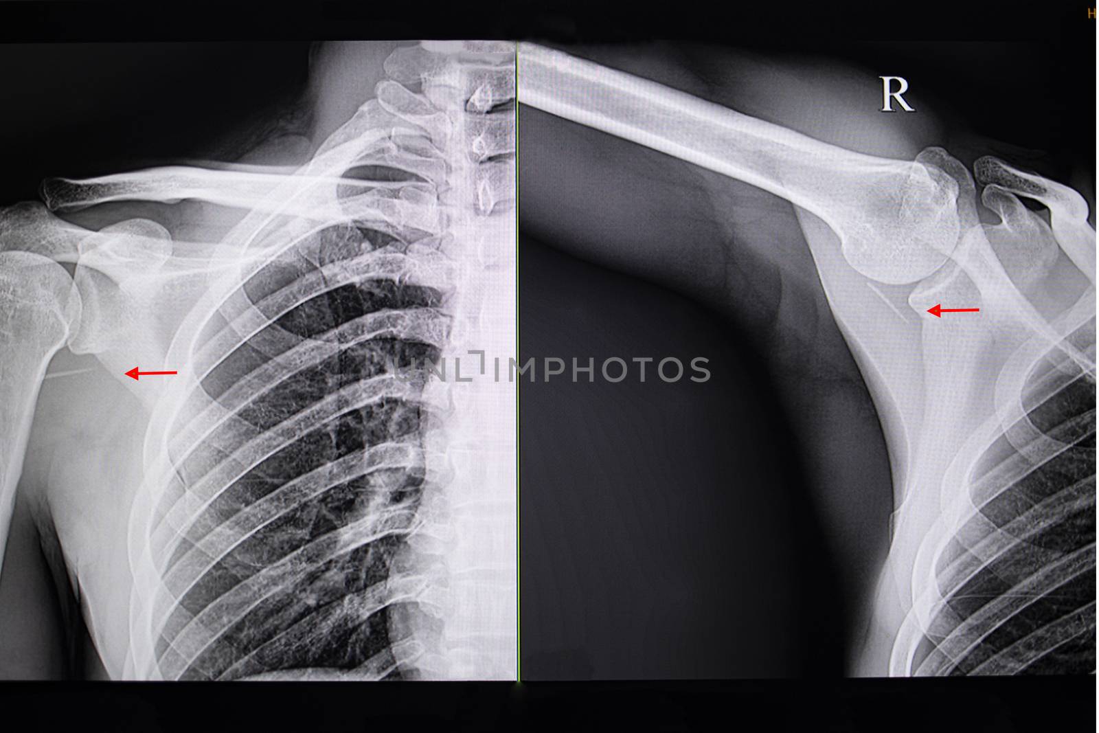 Fish bone retention injury by Nawoot