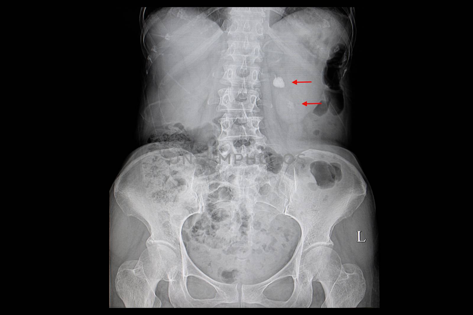 Xray film of a patient with a large stone in the right renal pelvis and calcification in the lower pole of the kidney.