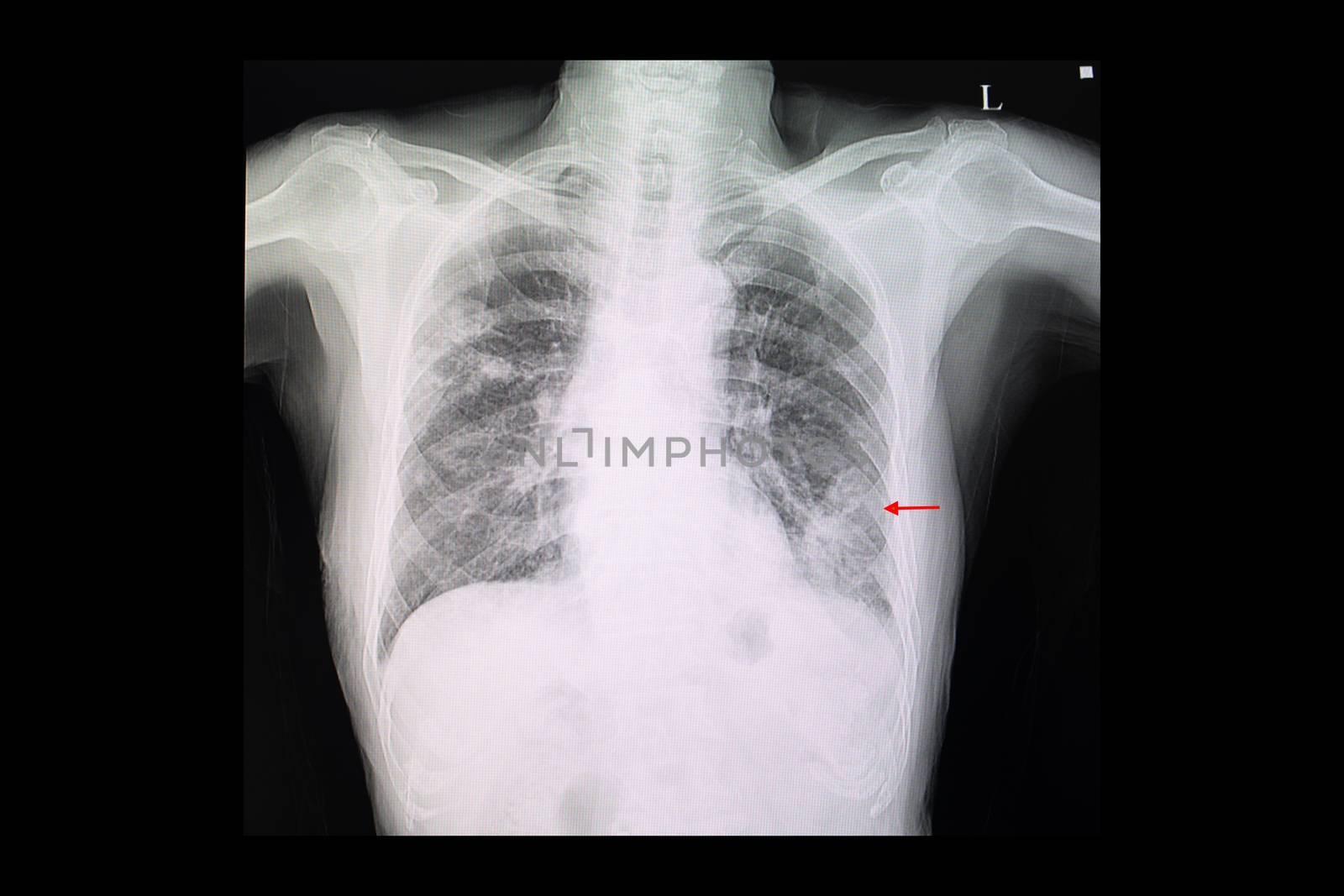 A chest x-ray film of left lower lung pneumonia by Nawoot
