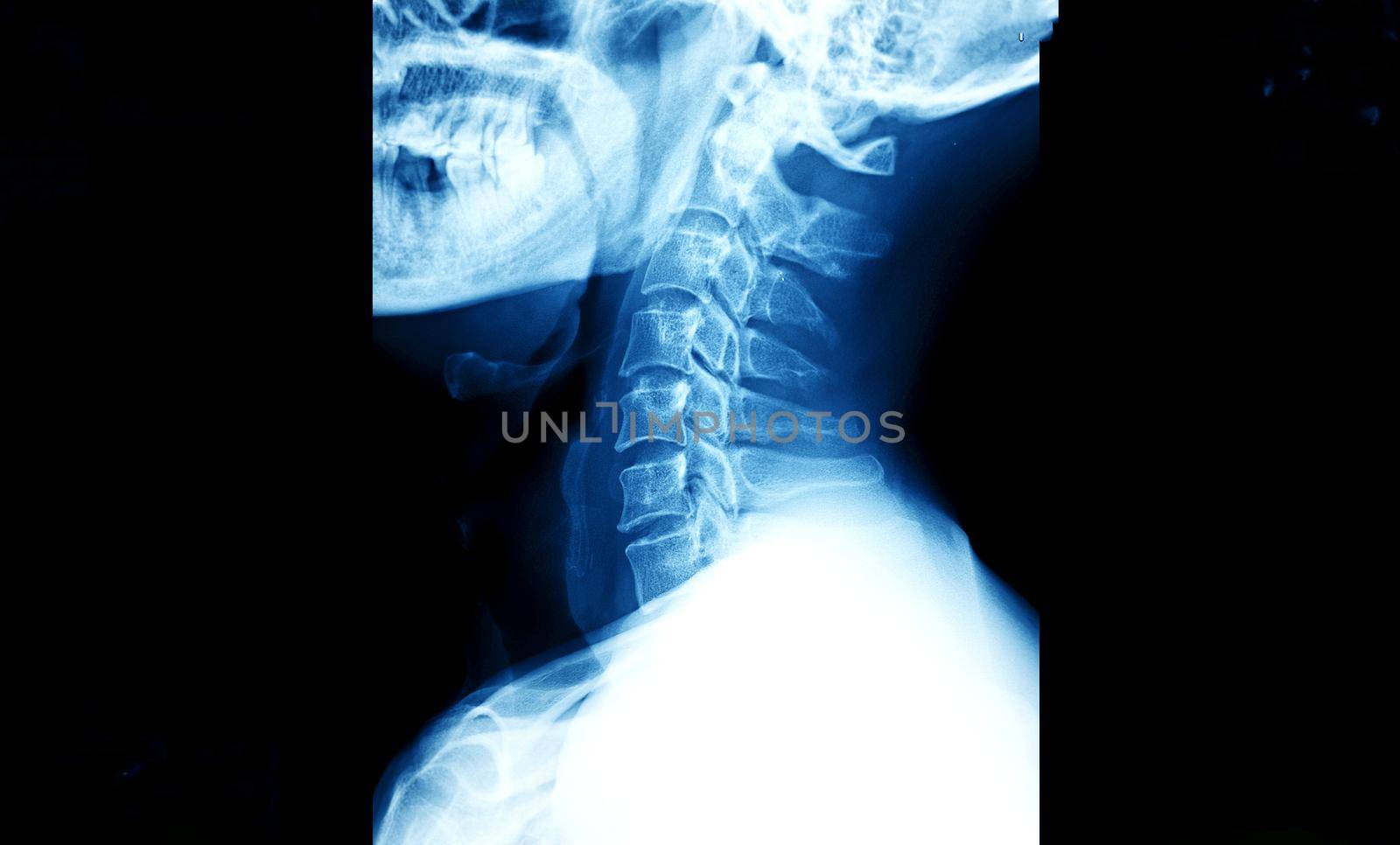 Film x-ray skull and cervical spine lateral view, X-Ray film of human bones from nose to chest.