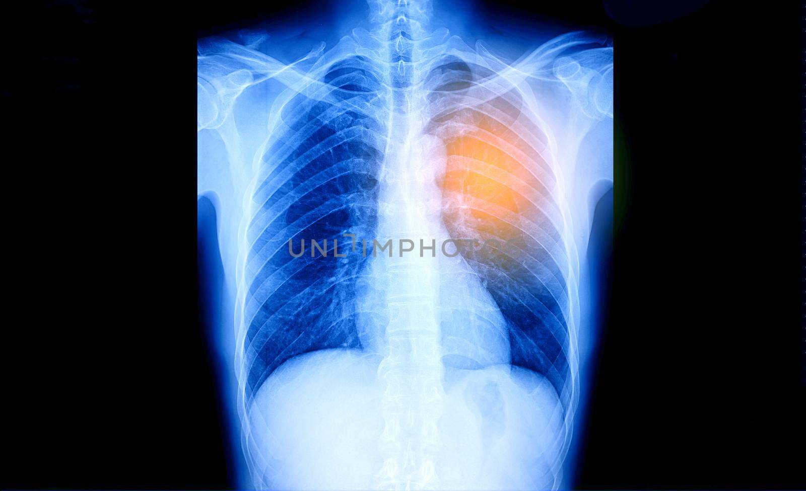 X-Ray Image Of Human Chest for a medical diagnosis, coronavirus or Covid-19 concept