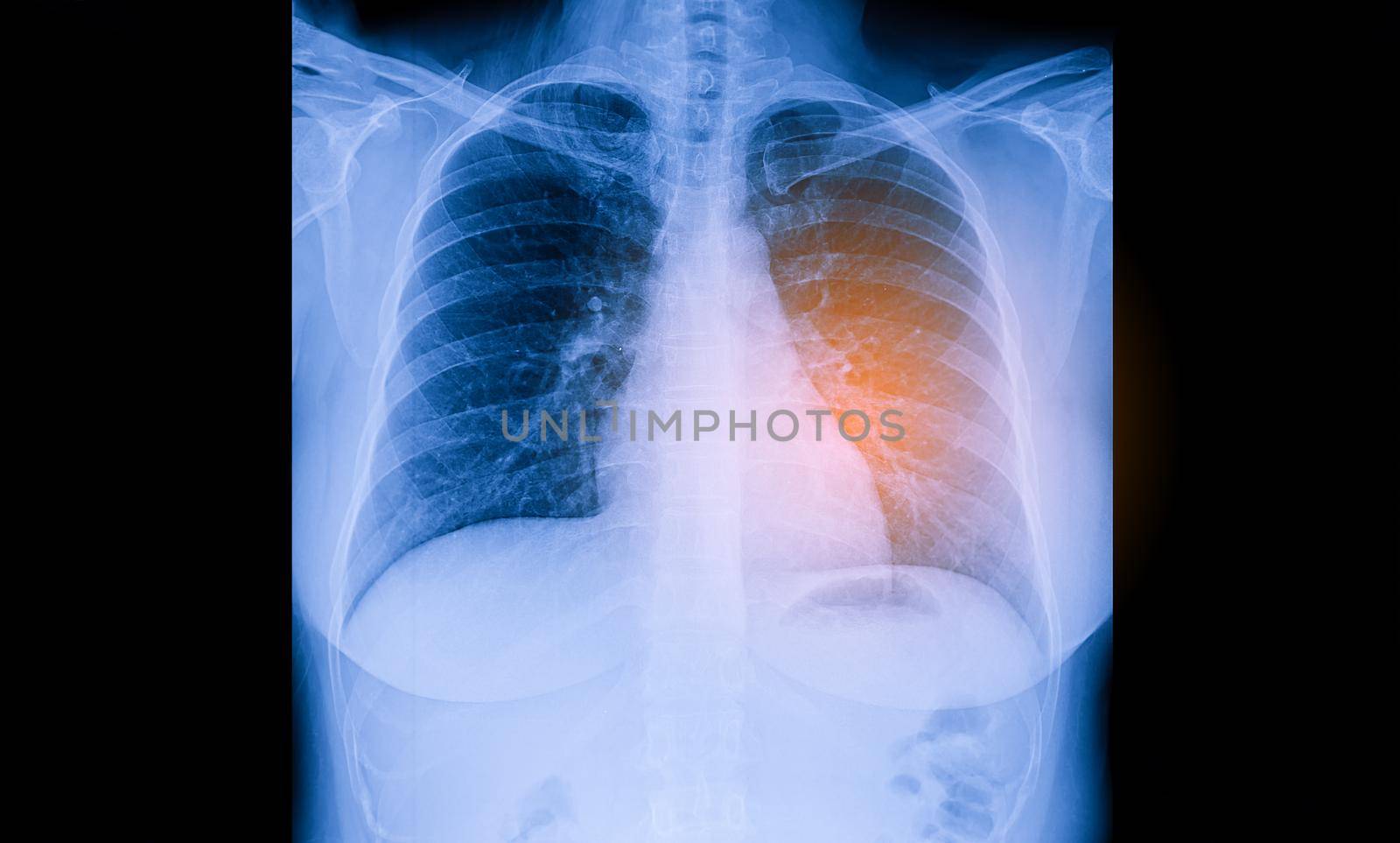 X-Ray Image Of Human Chest for a medical diagnosis, coronavirus or Covid-19 concept