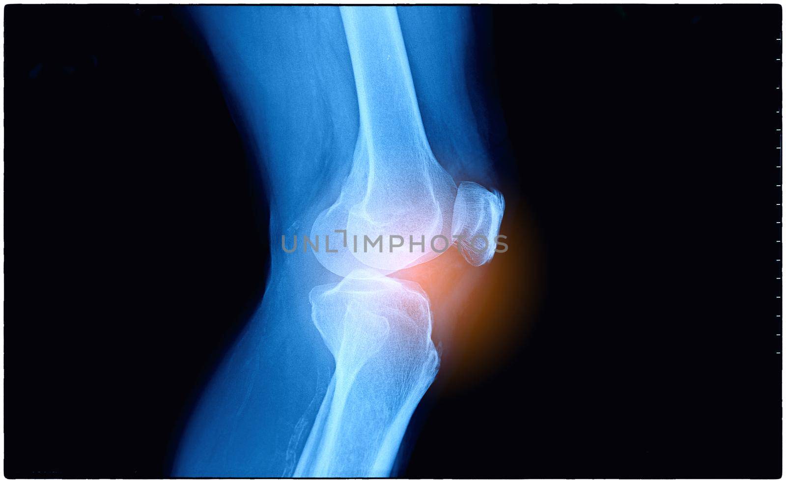 X-rays of leg fracture patients by chuanchai