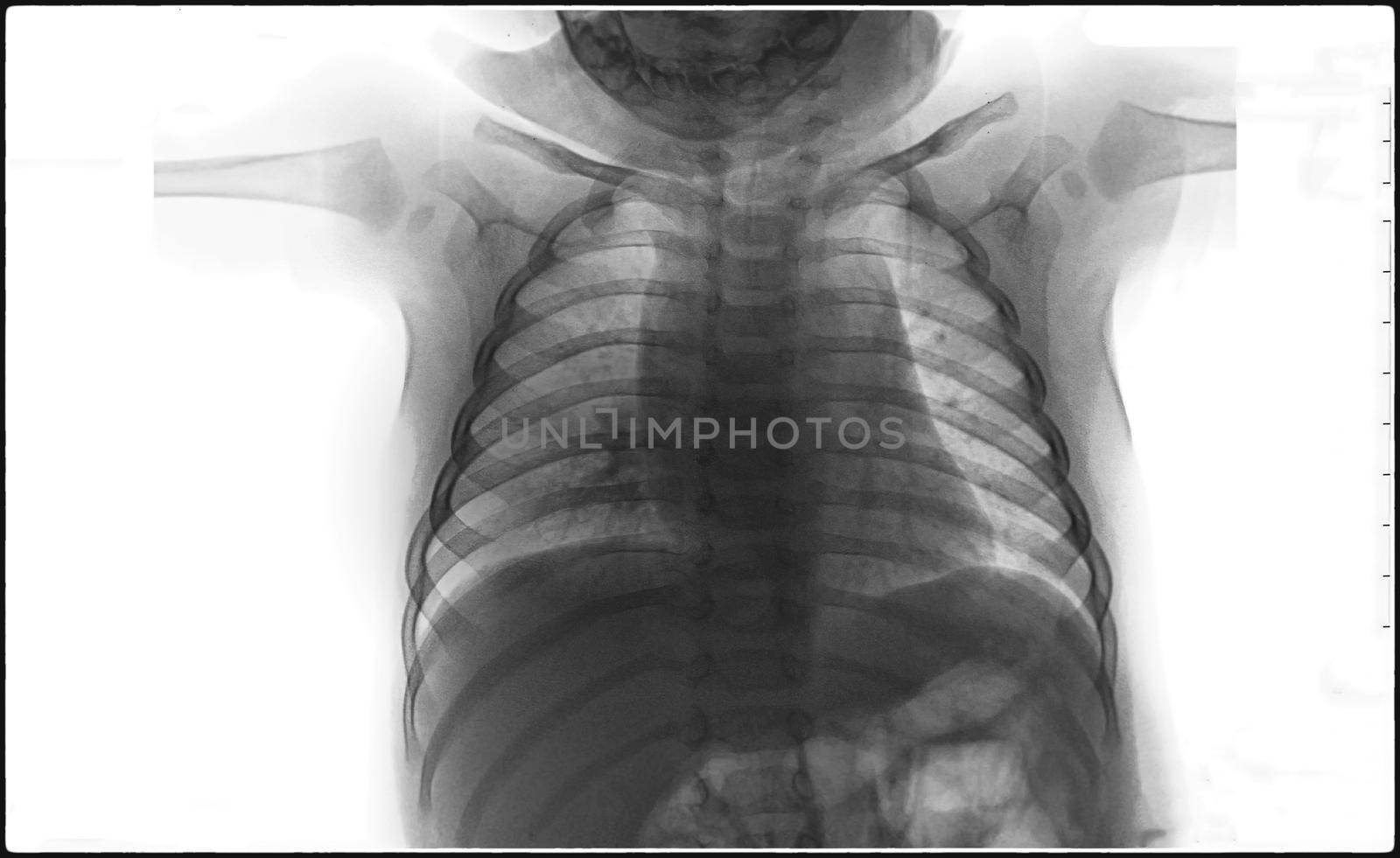 X-Ray Image Of Human Chest for a medical diagnosis, coronavirus or Covid-19 concept by chuanchai