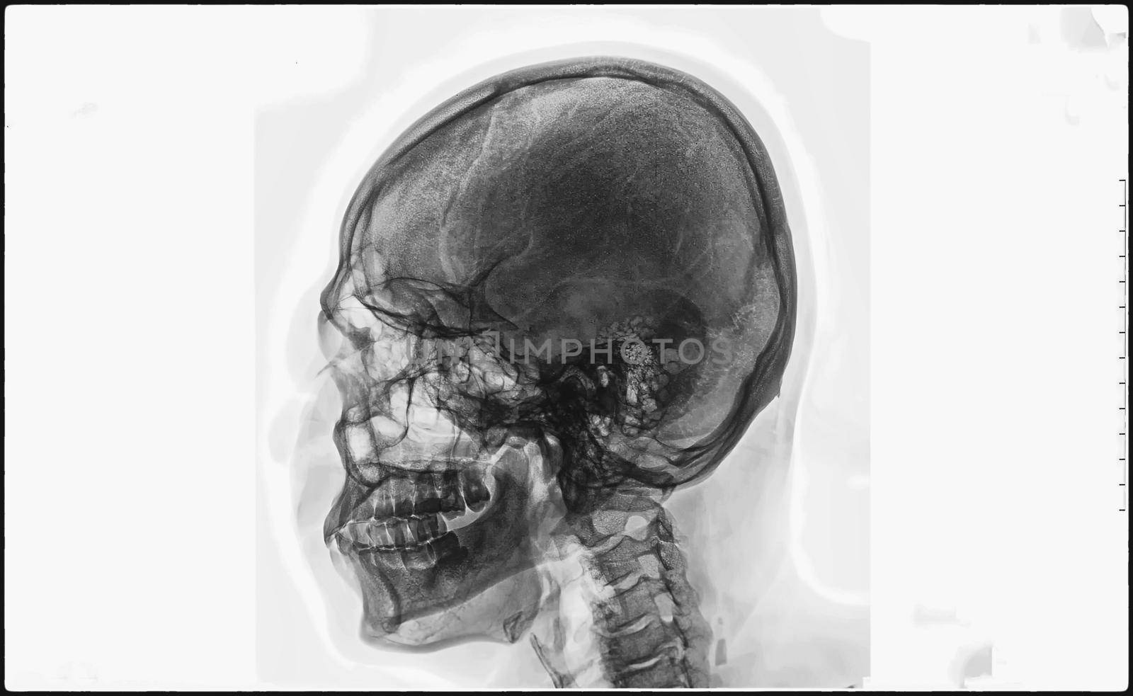 Film x-ray skull and cervical spine lateral view, X-Ray film of human bones from nose to chest. by chuanchai