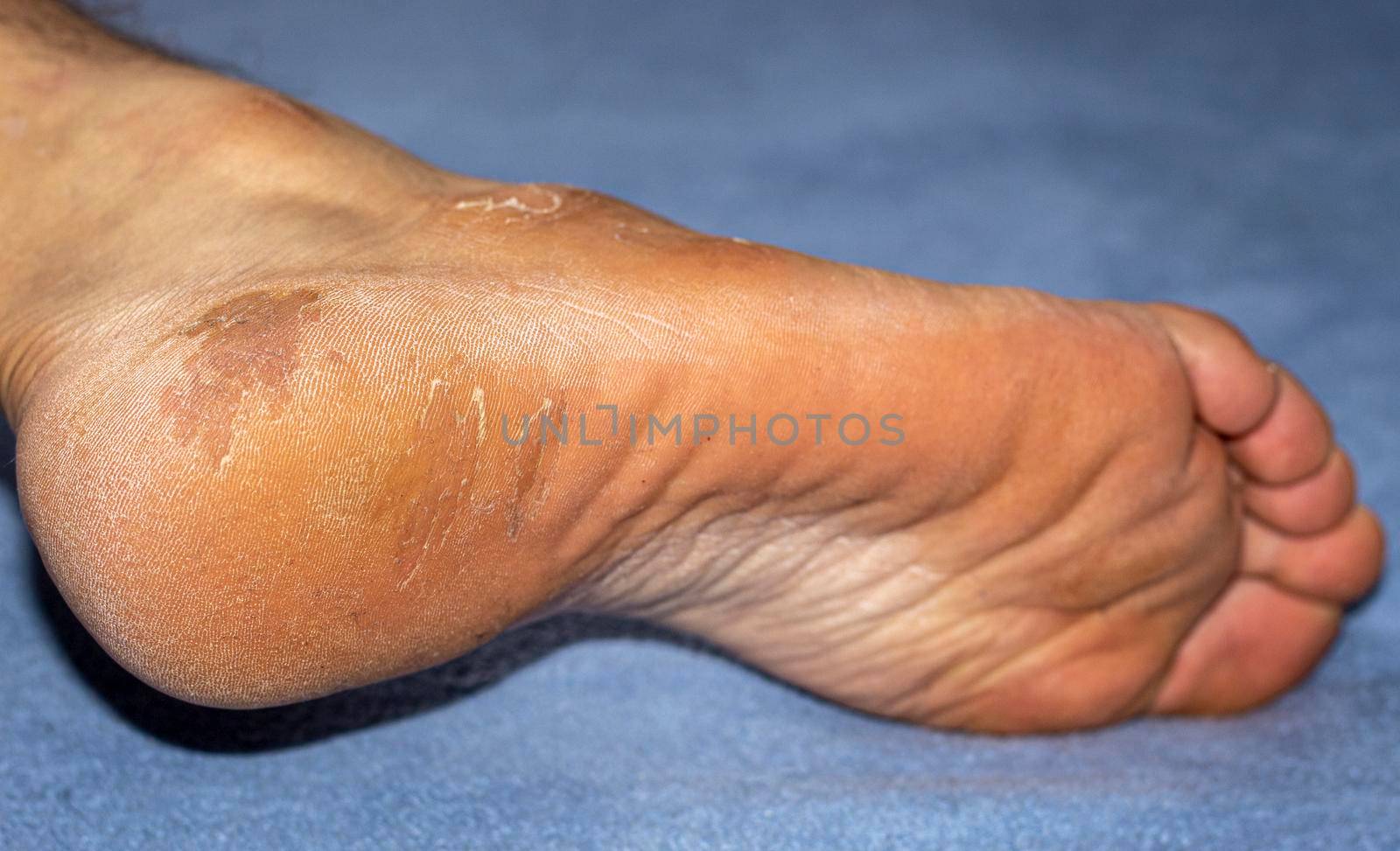 Heel disease with hard skin and itchy soles by bybyphotography