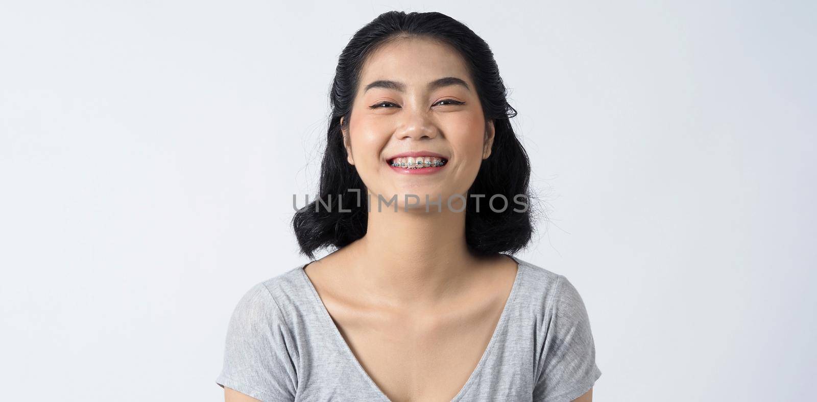 Dental braces of teen asian woman wearing braces teeth and contact lenses by gnepphoto