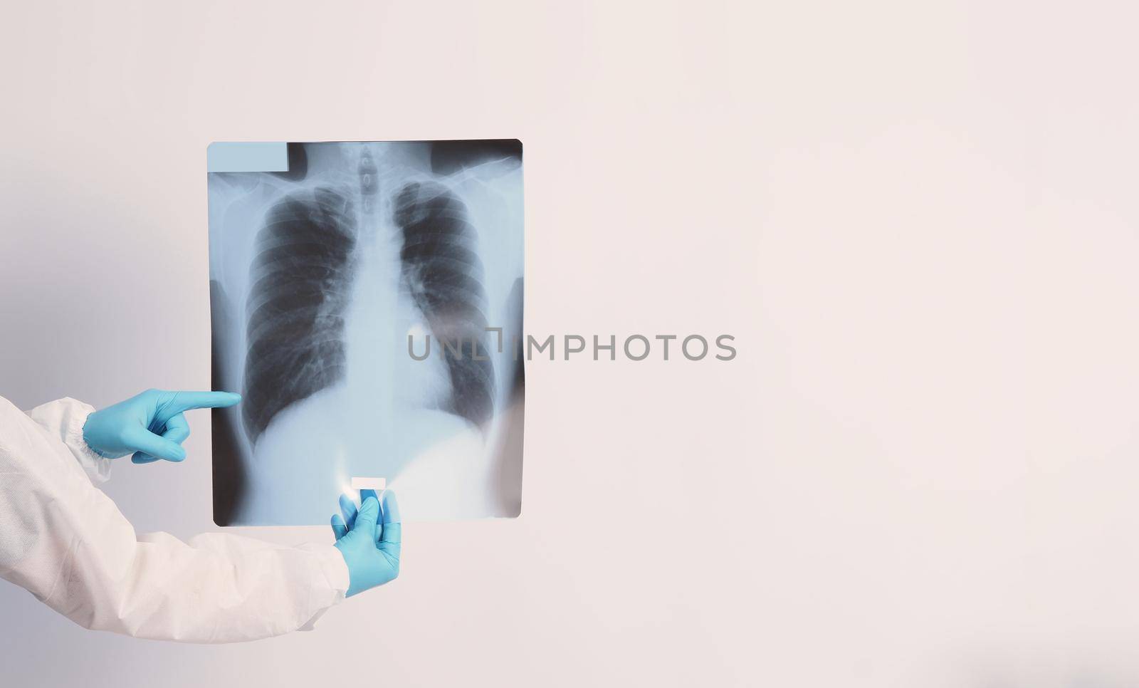 Xray film of Covid 19 lung damage and holding by doctor hand in medical glove and PPE by gnepphoto