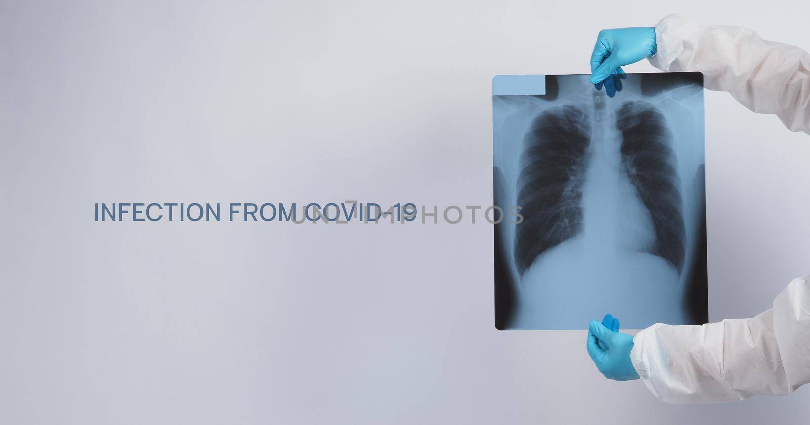 Xray film of Covid 19 lung damage and holding by doctor hand in medical glove and PPE by gnepphoto