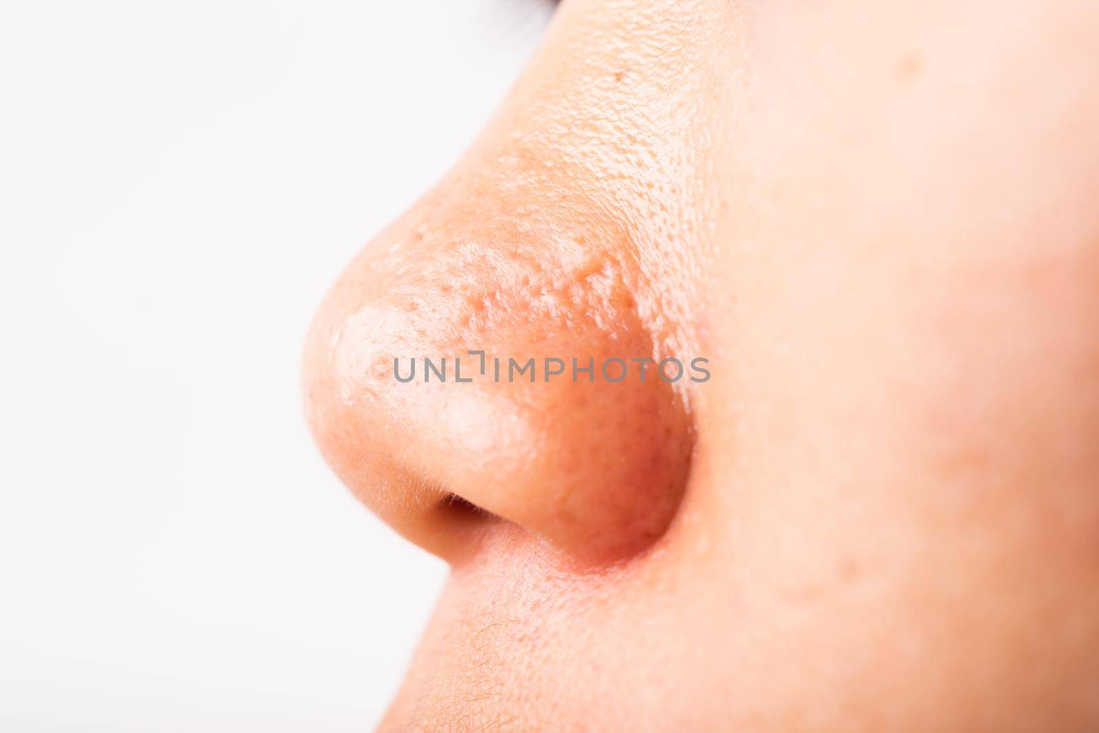 Closeup Asian young woman large pores have freckles cheek oily, acne pimple on nose, studio shot isolated on white background, Healthcare beauty skin face problem concept