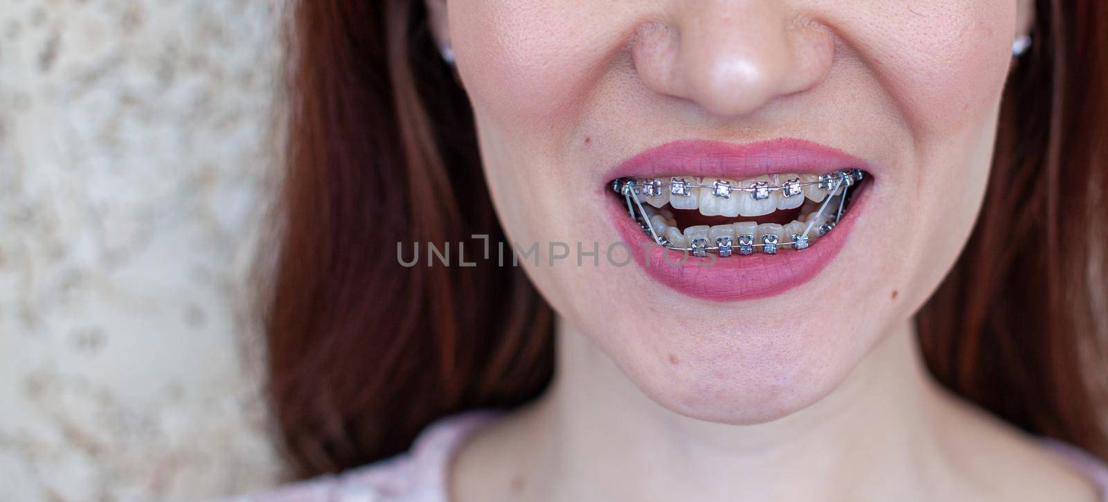 Brasket system in a girl's smiling mouth, macro photography of teeth. large face and painted lips. Braces on the teeth of a girl who smiles.