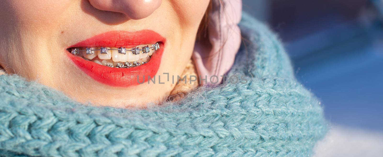 The girl has braces on her teeth. A girl in the winter on the street smiles and braces are visible on her teeth. Smooth teeth from the installation of braces