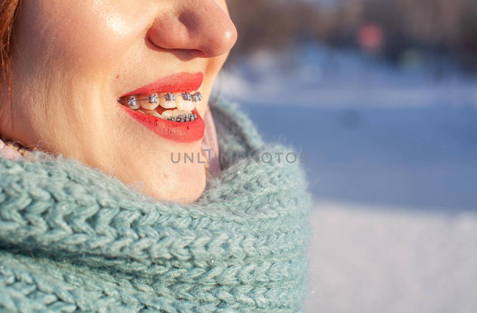 Girl on the street smiles and braces are visible on her teeth by AnatoliiFoto