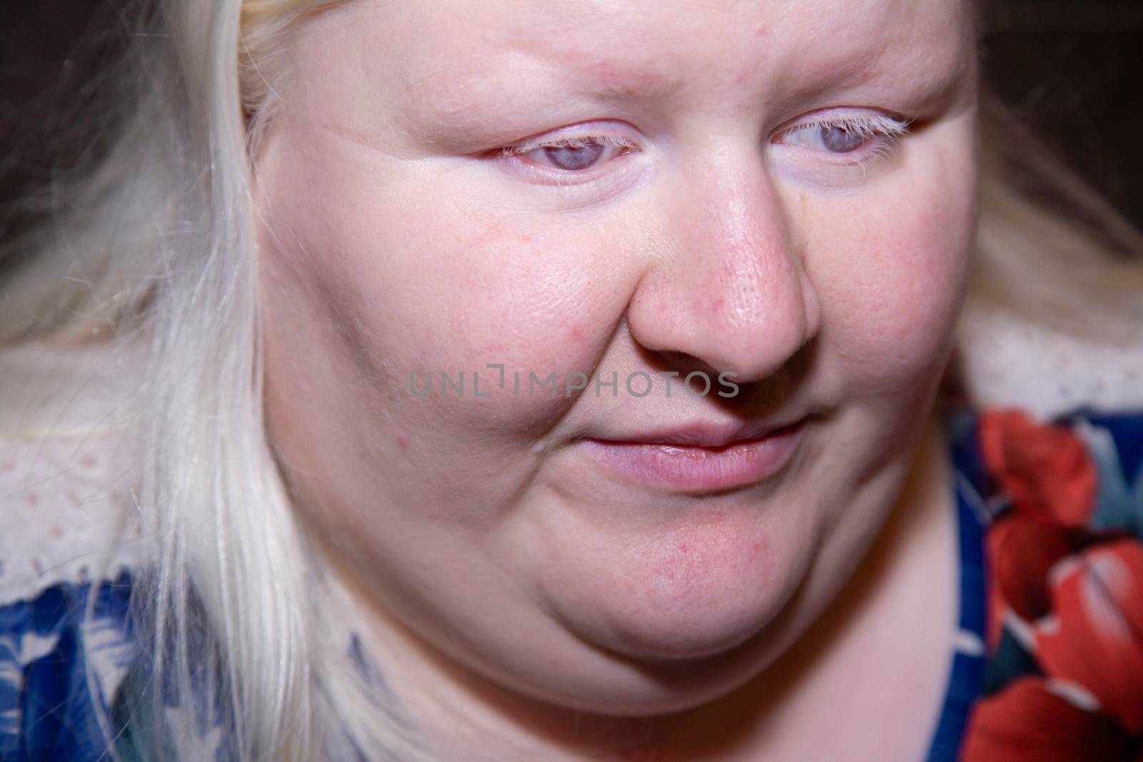 Sad Albino Woman by tornado98