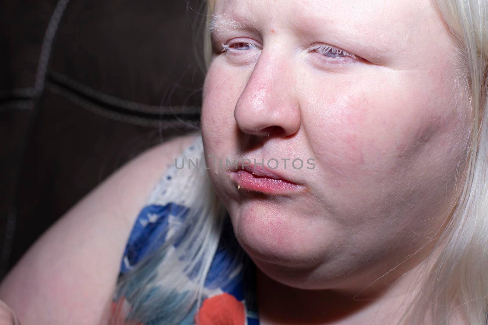 Obese, albino woman with crumbs on her lips