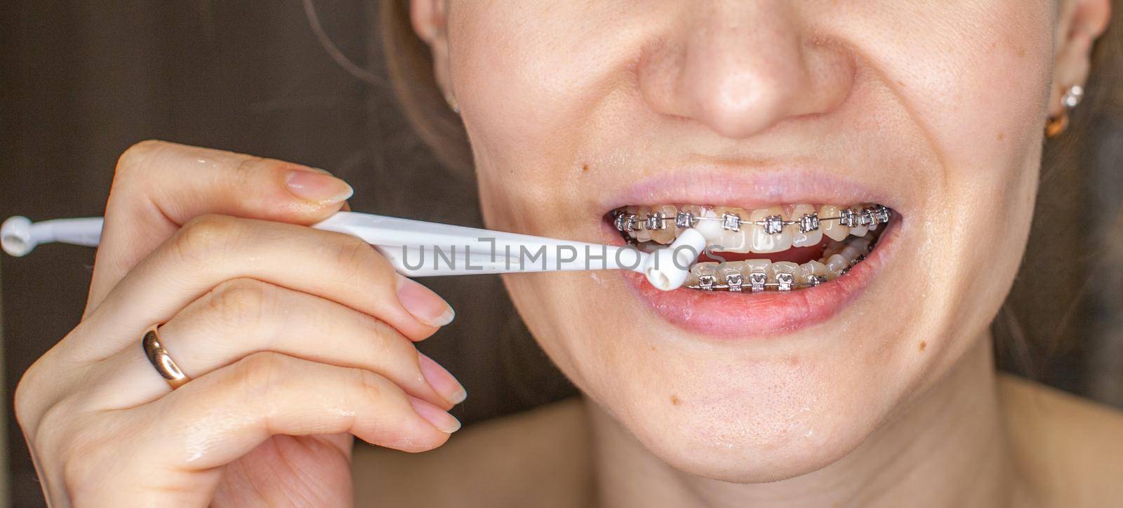 Girl with braces on her teeth brushing her teeth with a toothbrush, close-up. Dental and oral care. Braces for leveling teeth