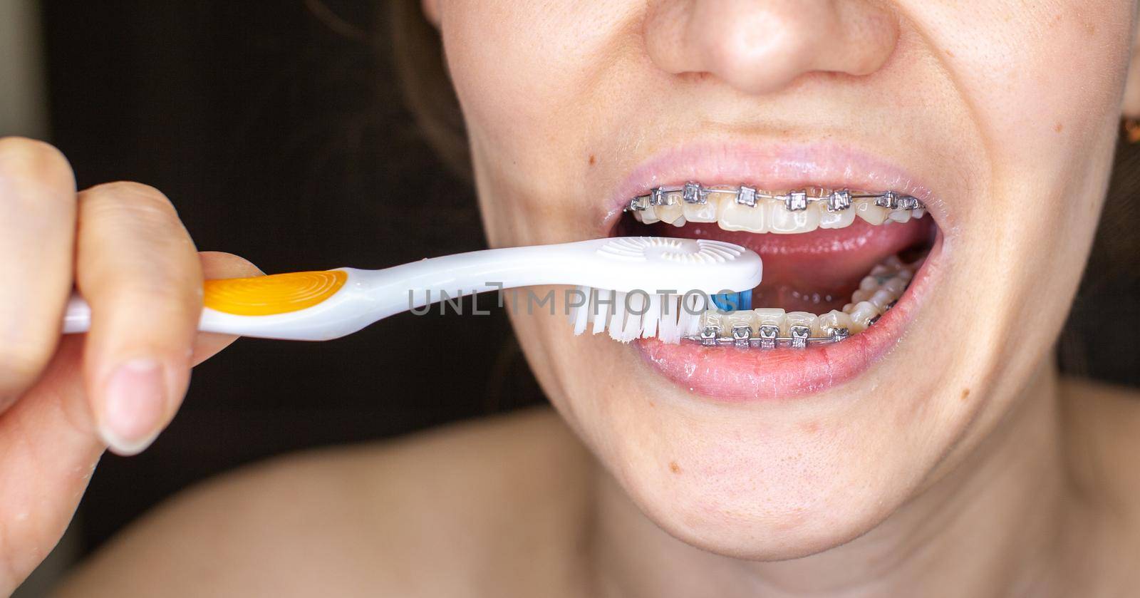 Girl with braces on her teeth brushing her teeth with a toothbrush by AnatoliiFoto
