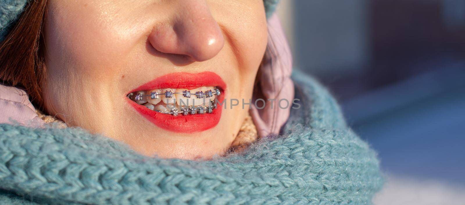 Girl on the street smiles and braces are visible on her teeth by AnatoliiFoto