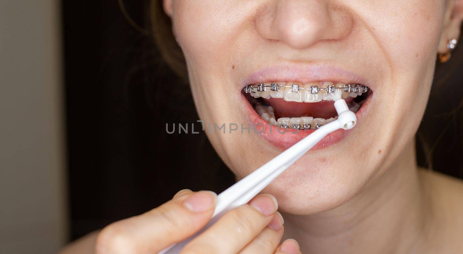 Girl with braces on her teeth brushing her teeth with a toothbrush by AnatoliiFoto