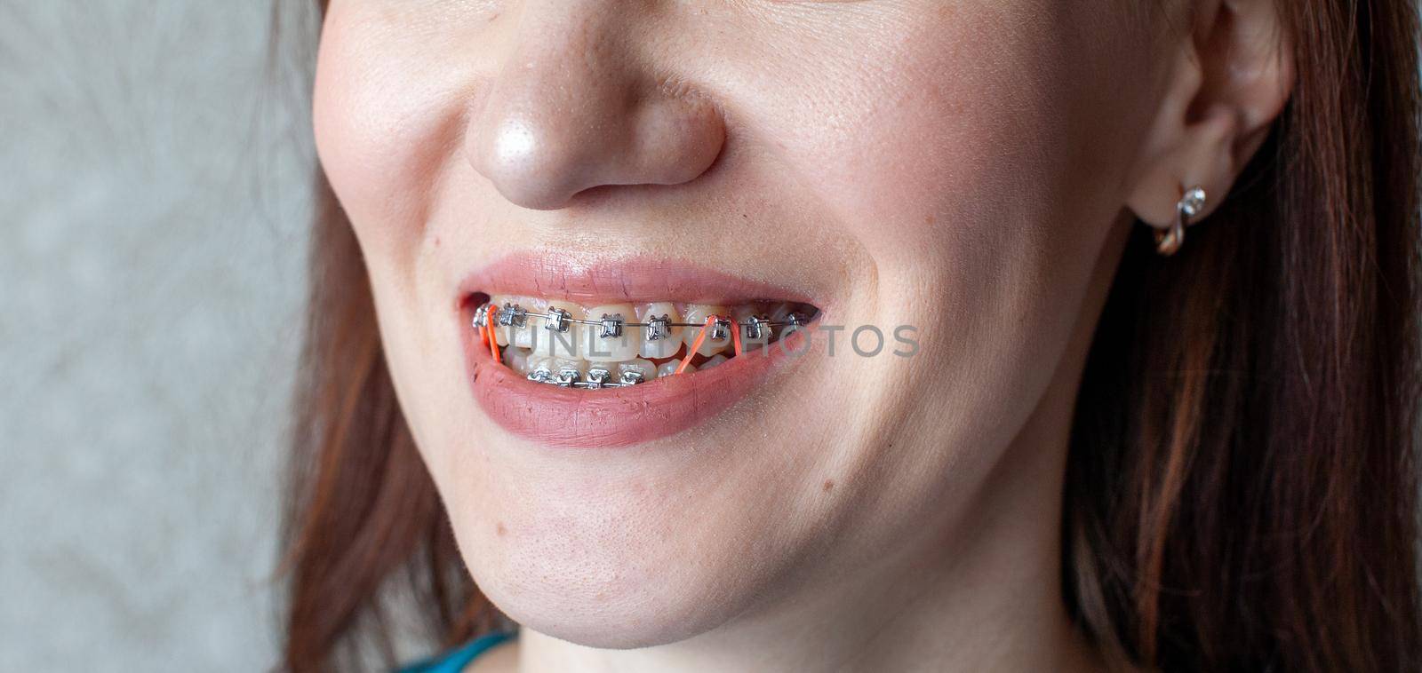 Brasket system in a girl's smiling mouth, macro photography of teeth. large face and painted lips. Braces on the teeth of a girl who smiles.