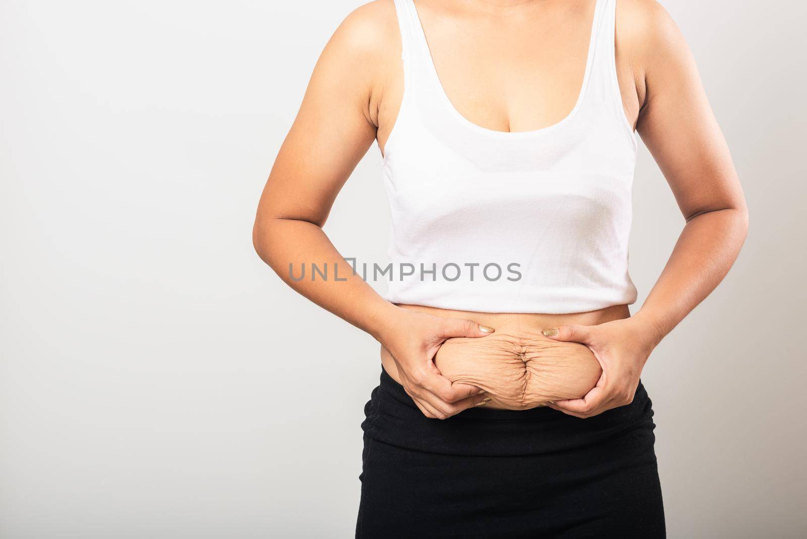 woman showing stretch mark loose lower abdomen skin she fat after pregnancy baby birth by Sorapop