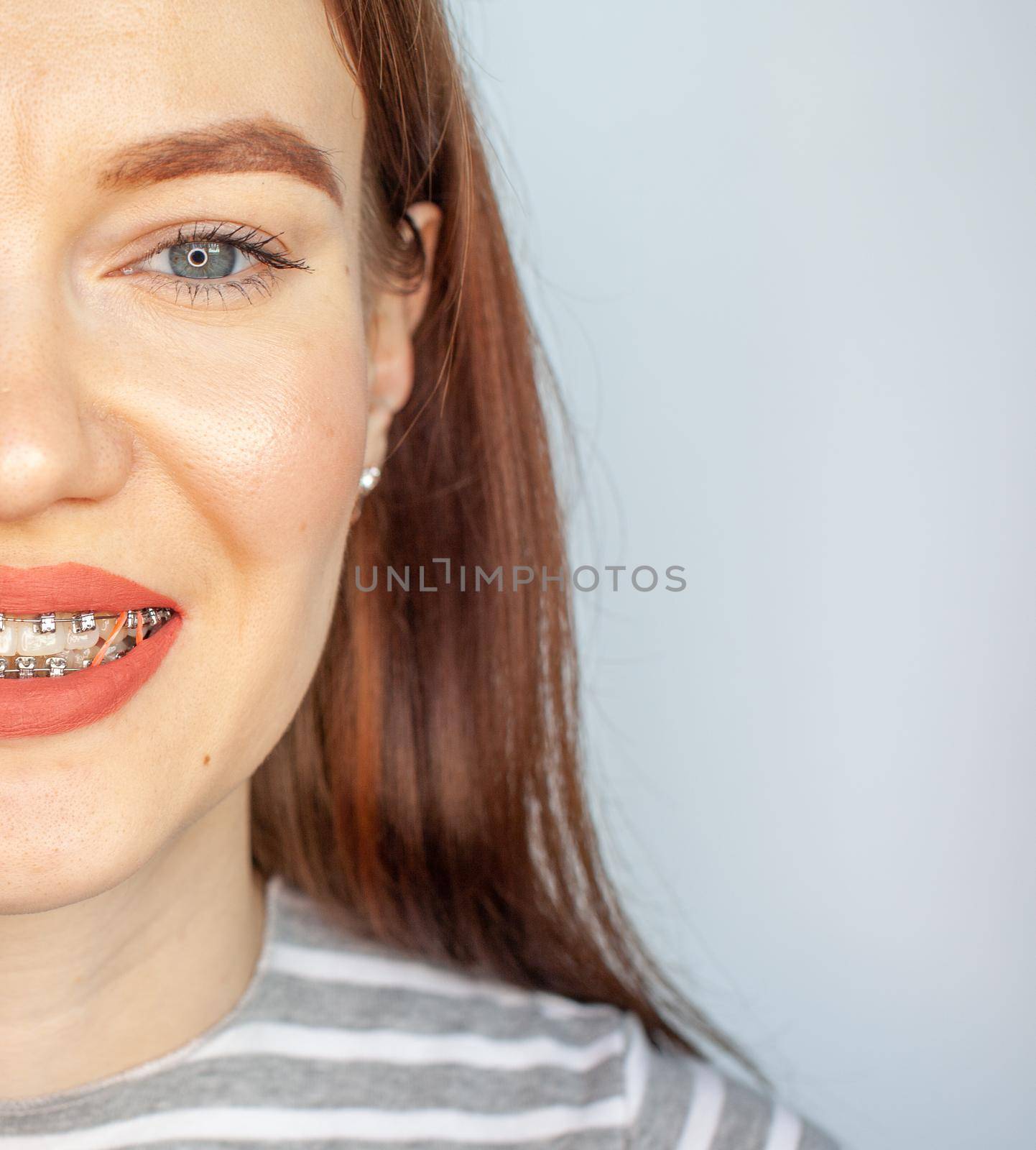 Braces in the smiling mouth of a girl. Smooth teeth from braces. by AnatoliiFoto