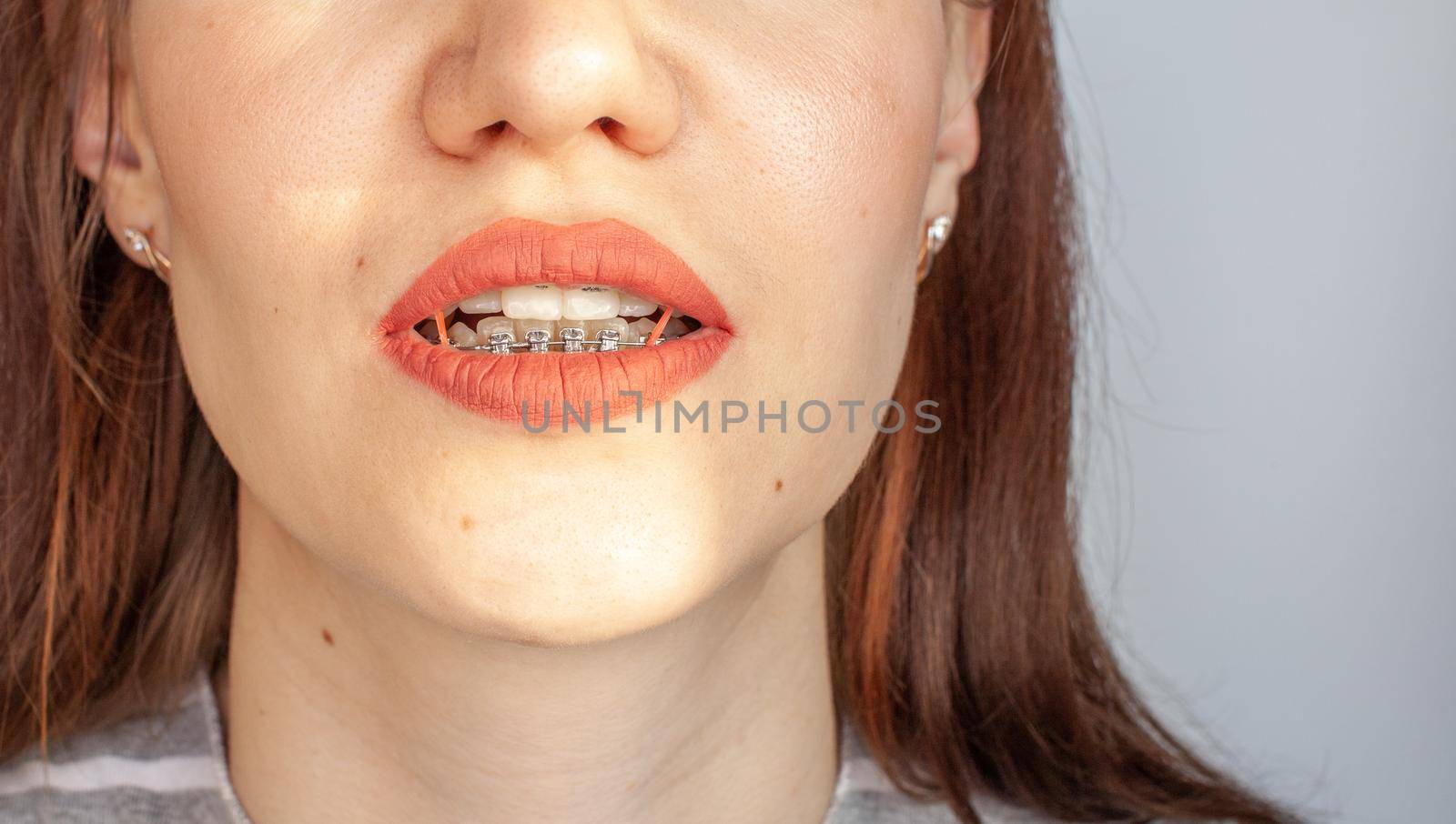 Braces in the smiling mouth of a girl. Close-up photos of teeth and lips. Smooth teeth from braces. On the teeth of elastic bands for tightening teeth. Photo on a light solid background.